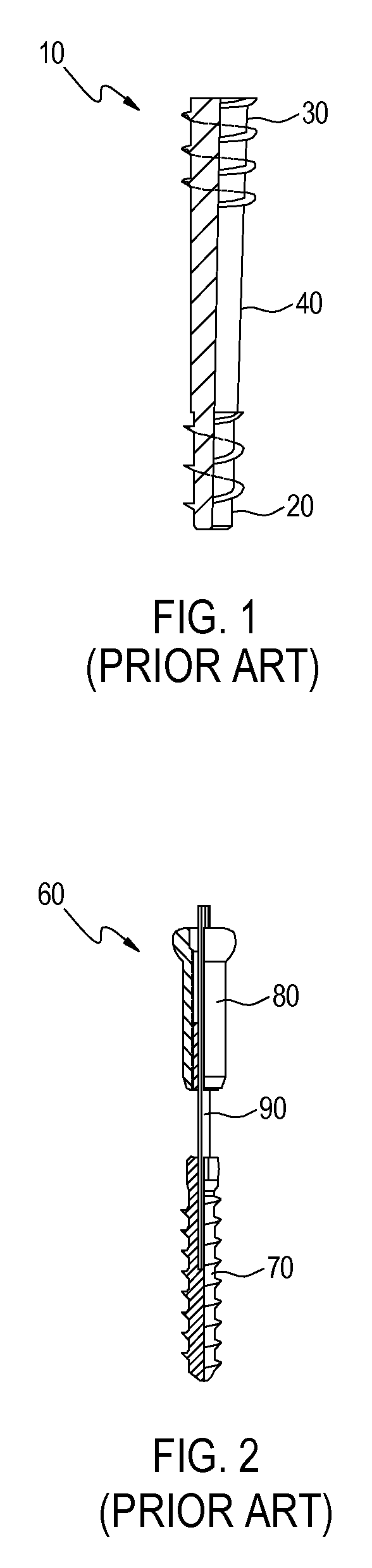 Bone screw, method for manufacturing the bone screw, and tool for mounting and removing the bone screw