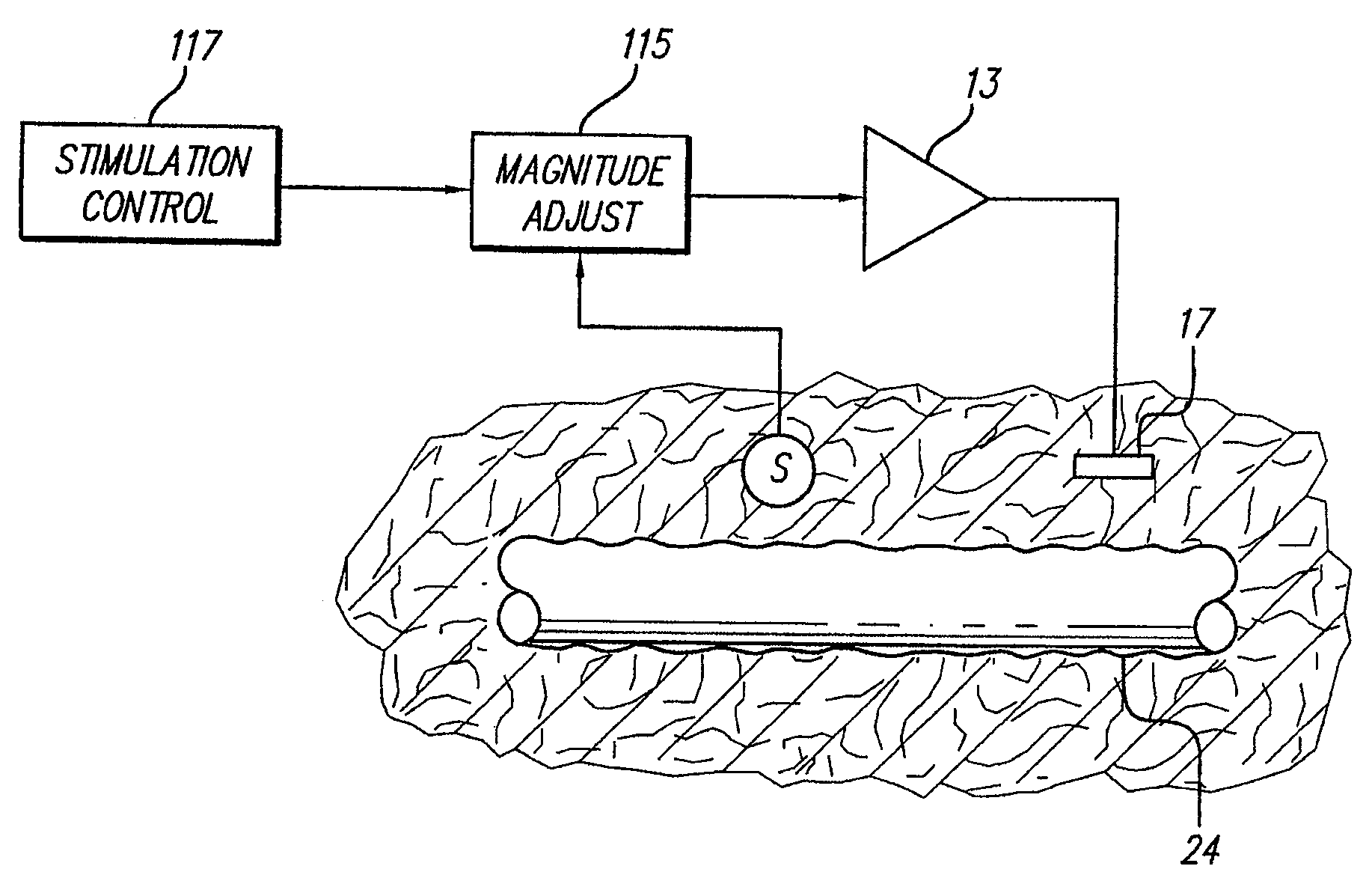 Neural stimulation system providing auto adjustment of stimulus output as a function of sensed pressure changes