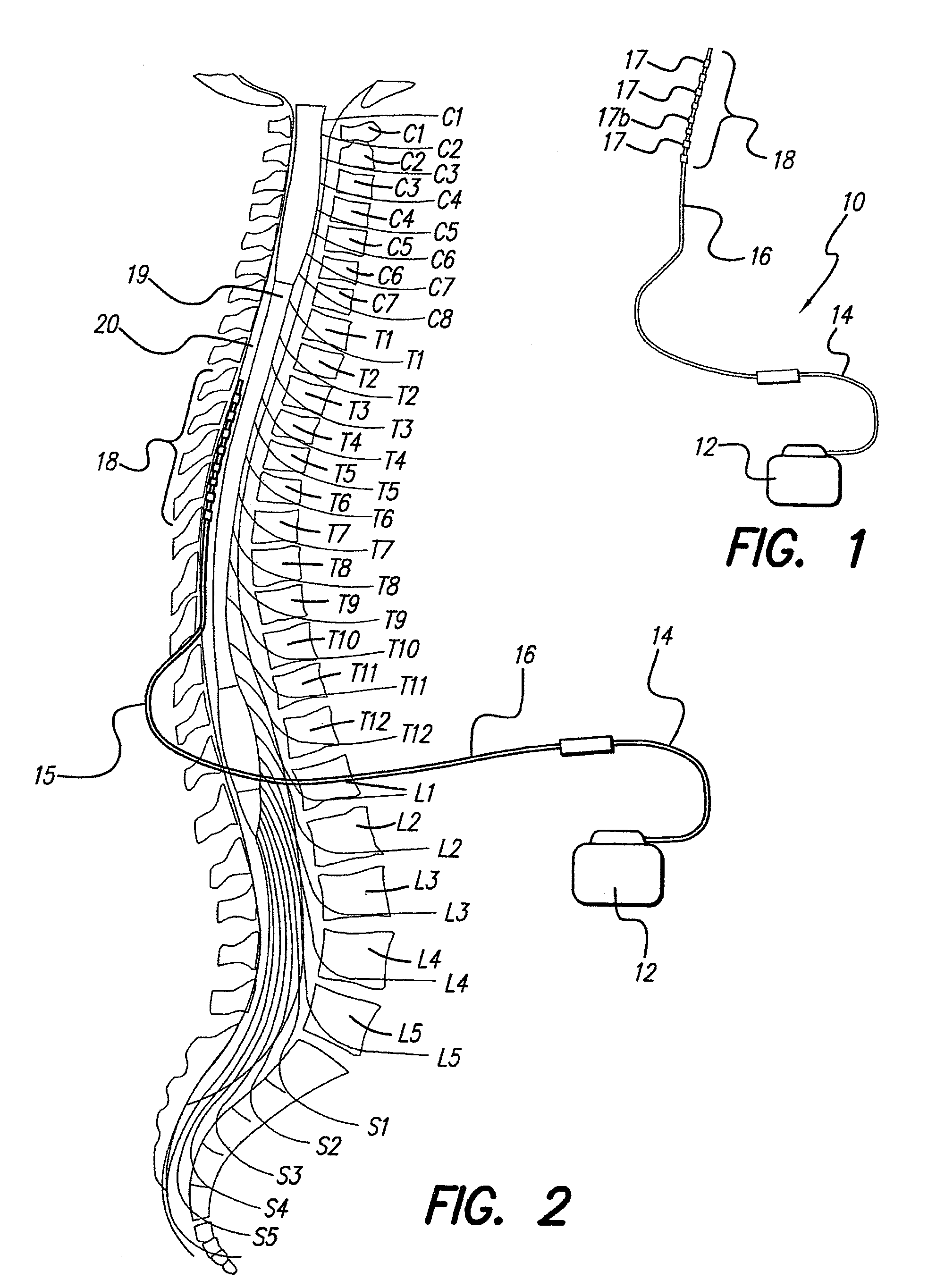 Neural stimulation system providing auto adjustment of stimulus output as a function of sensed pressure changes