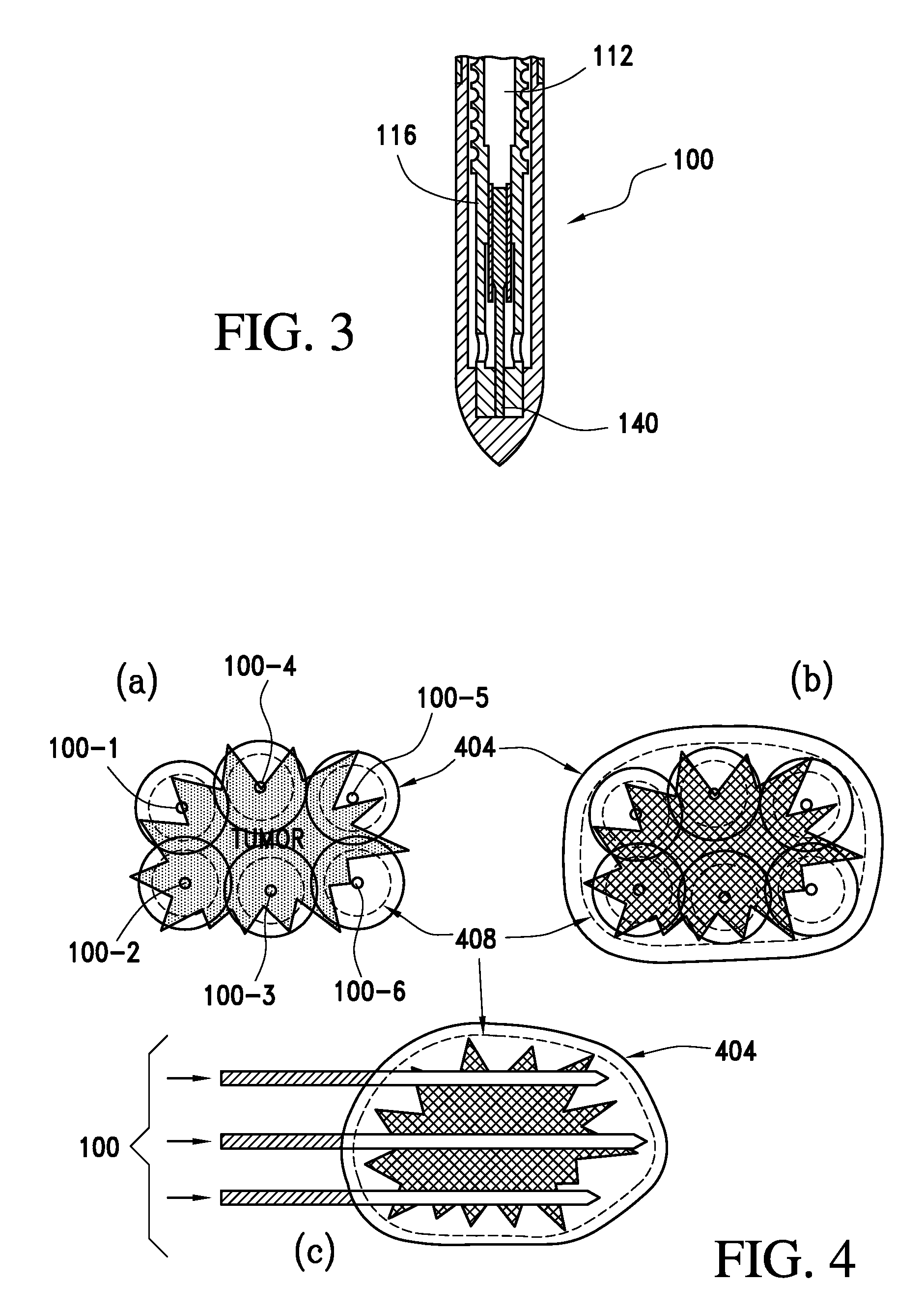 Cryotherapy probe