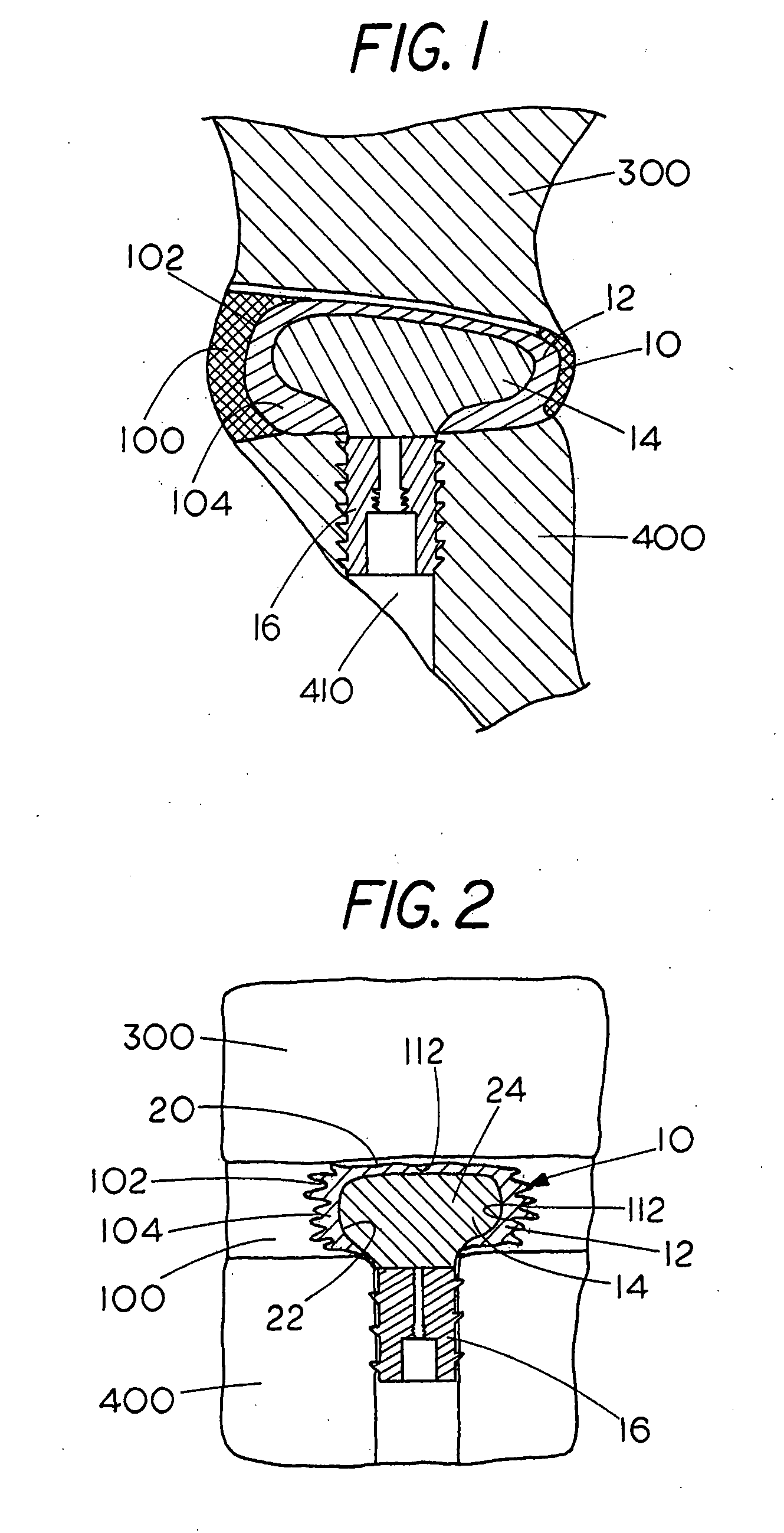 Prosthetic nucleus apparatus and method