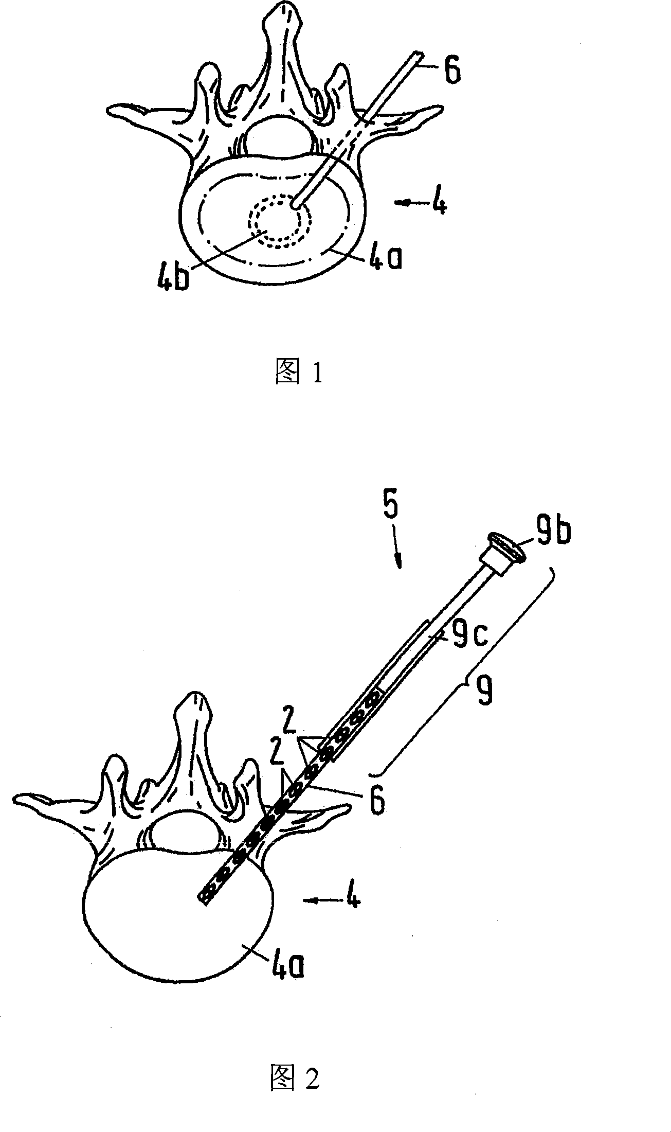 Filler and administration method and device for forming a supportive structure in a bone cavity