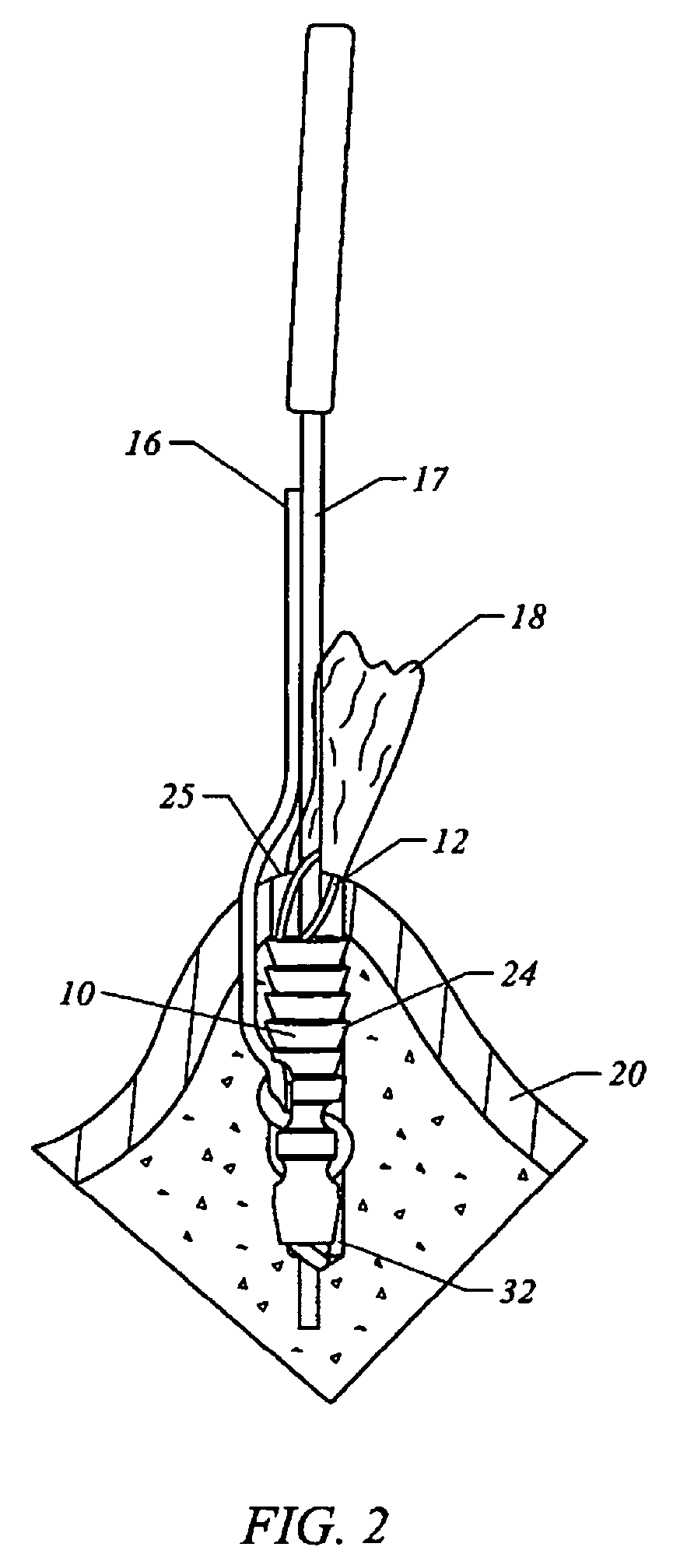 Bone anchor suture-loading system, method and apparatus