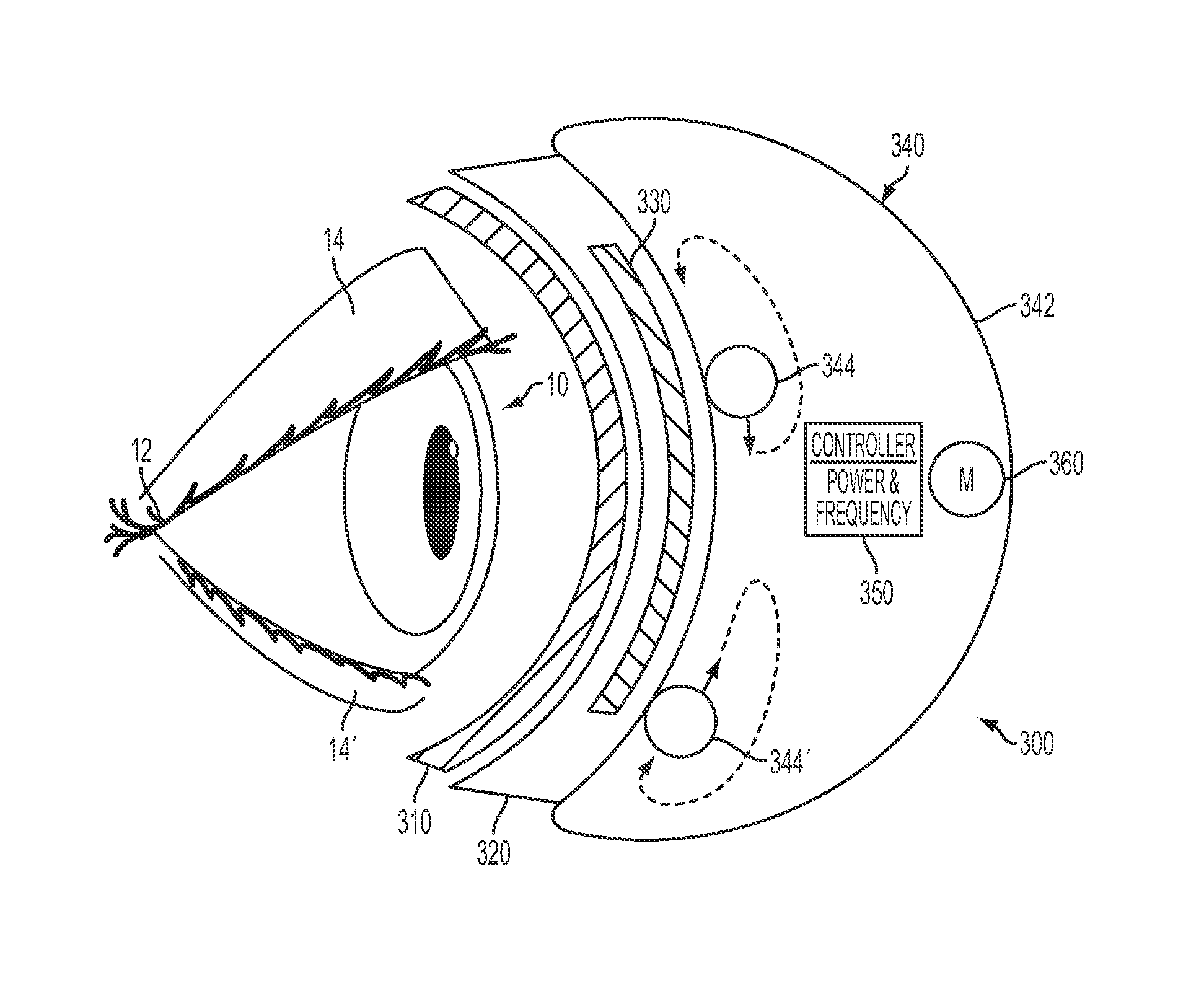 Systems, devices, kits and methods for therapy of the eye