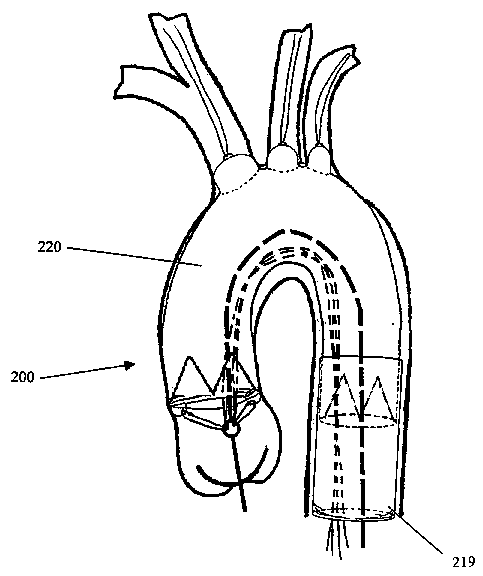 Exclusion of ascending/descending aorta and/or aortic arch aneurysm