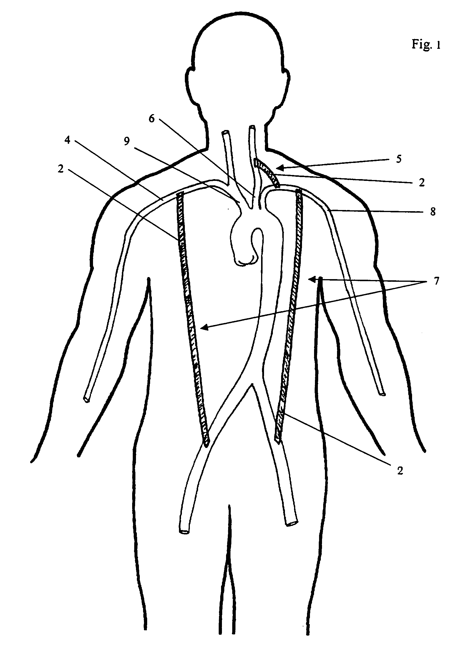 Exclusion of ascending/descending aorta and/or aortic arch aneurysm