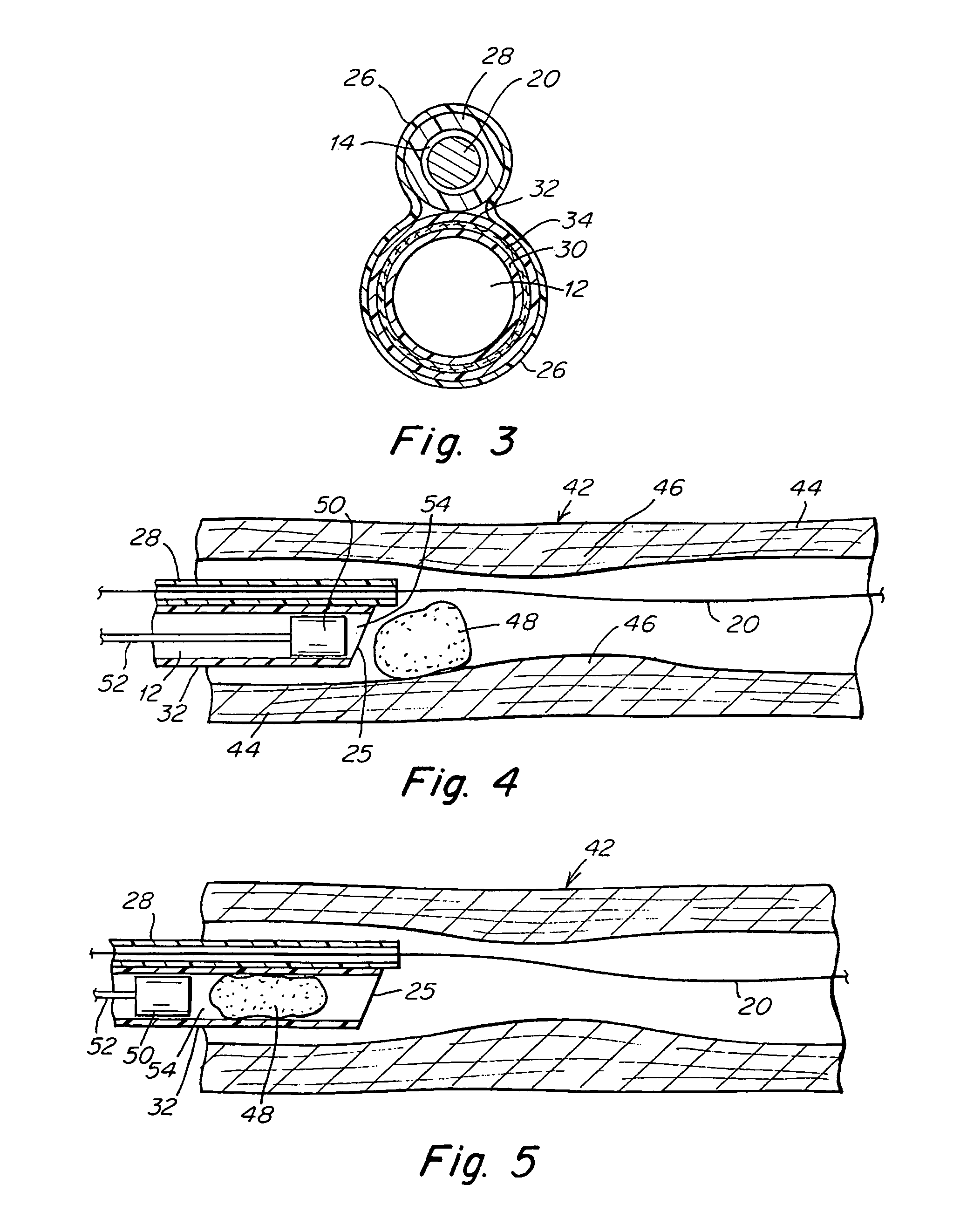 Aspiration catheter having an internal vacuum accumulator