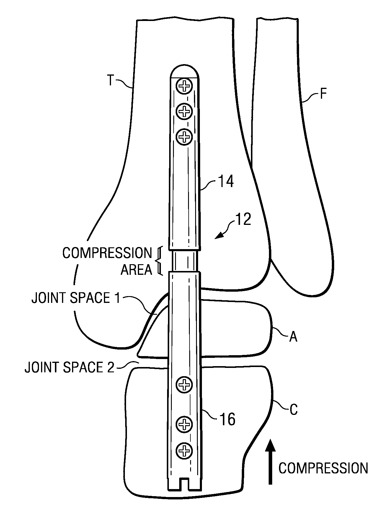 Ankle arthrodesis nail and outrigger assembly