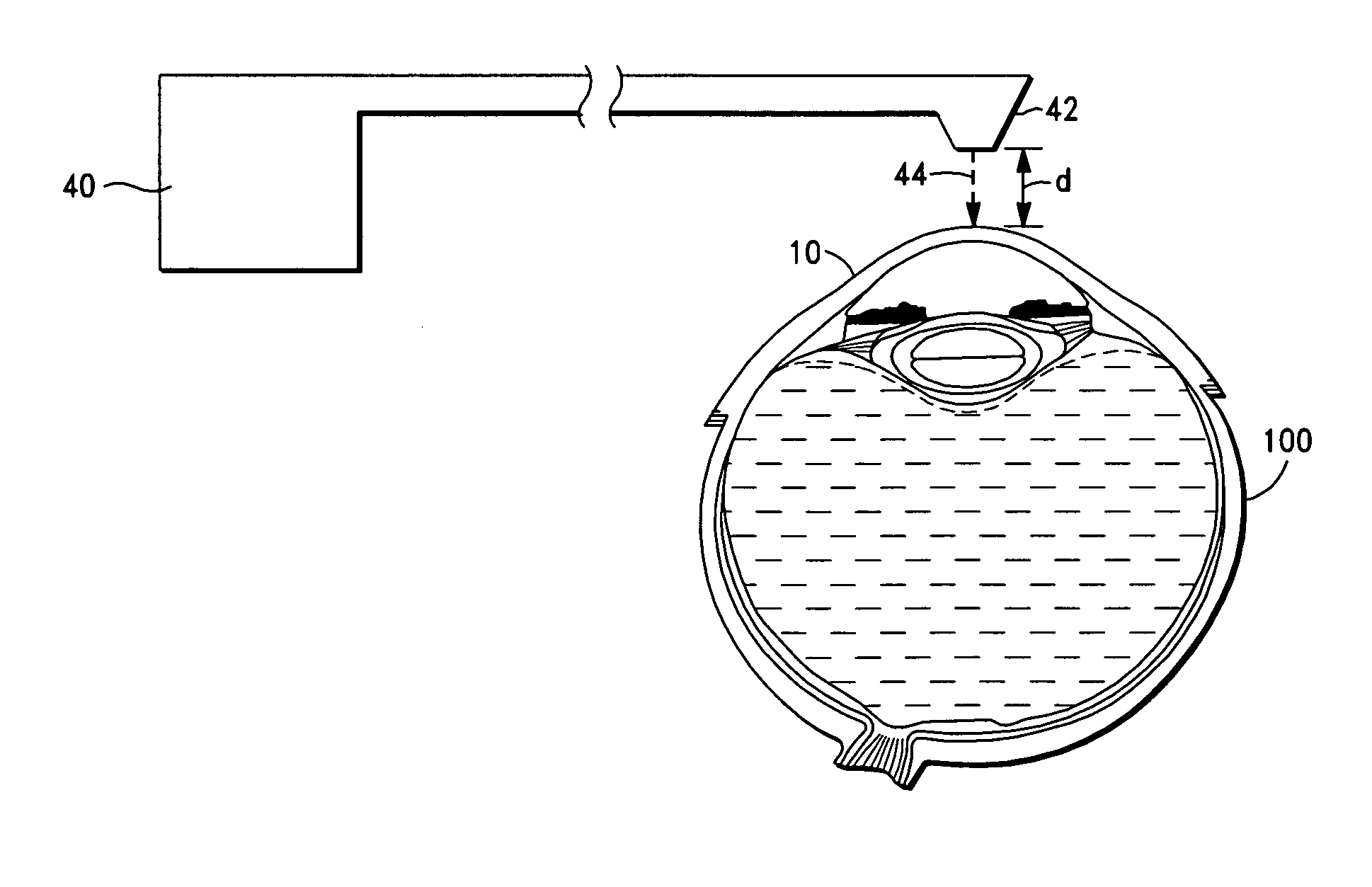 Laser-based methods and systems for corneal surgery