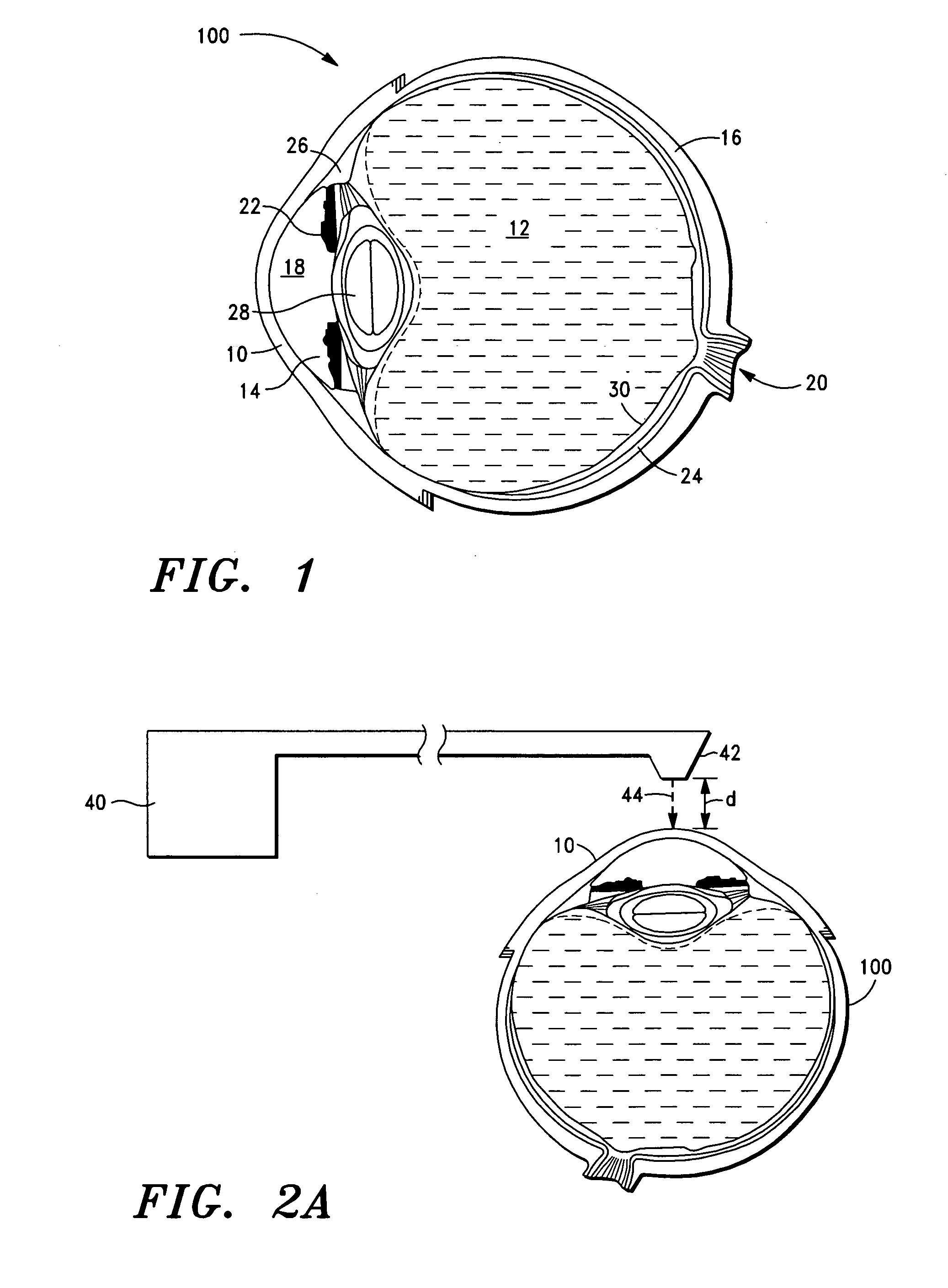 Laser-based methods and systems for corneal surgery