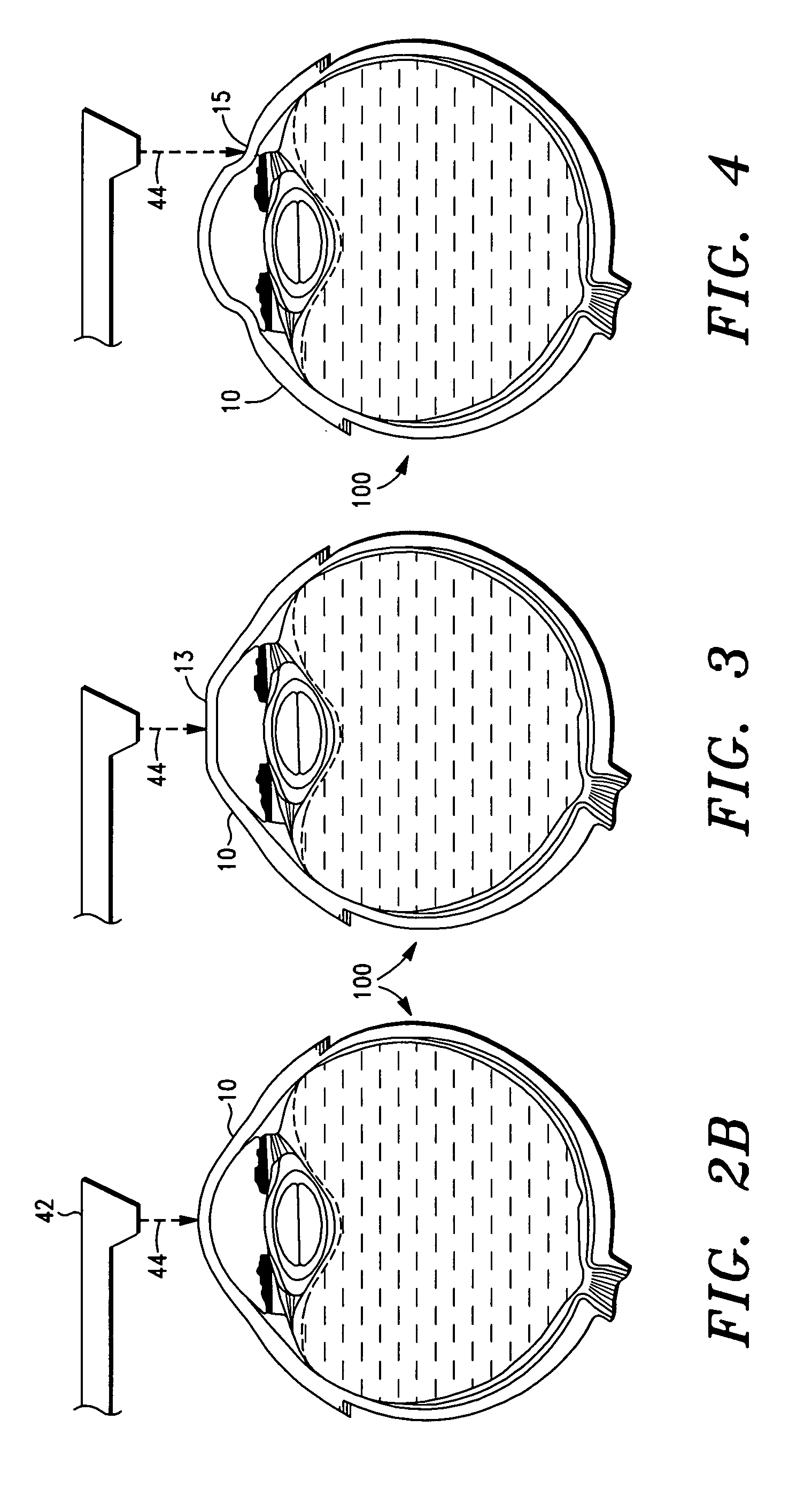 Laser-based methods and systems for corneal surgery