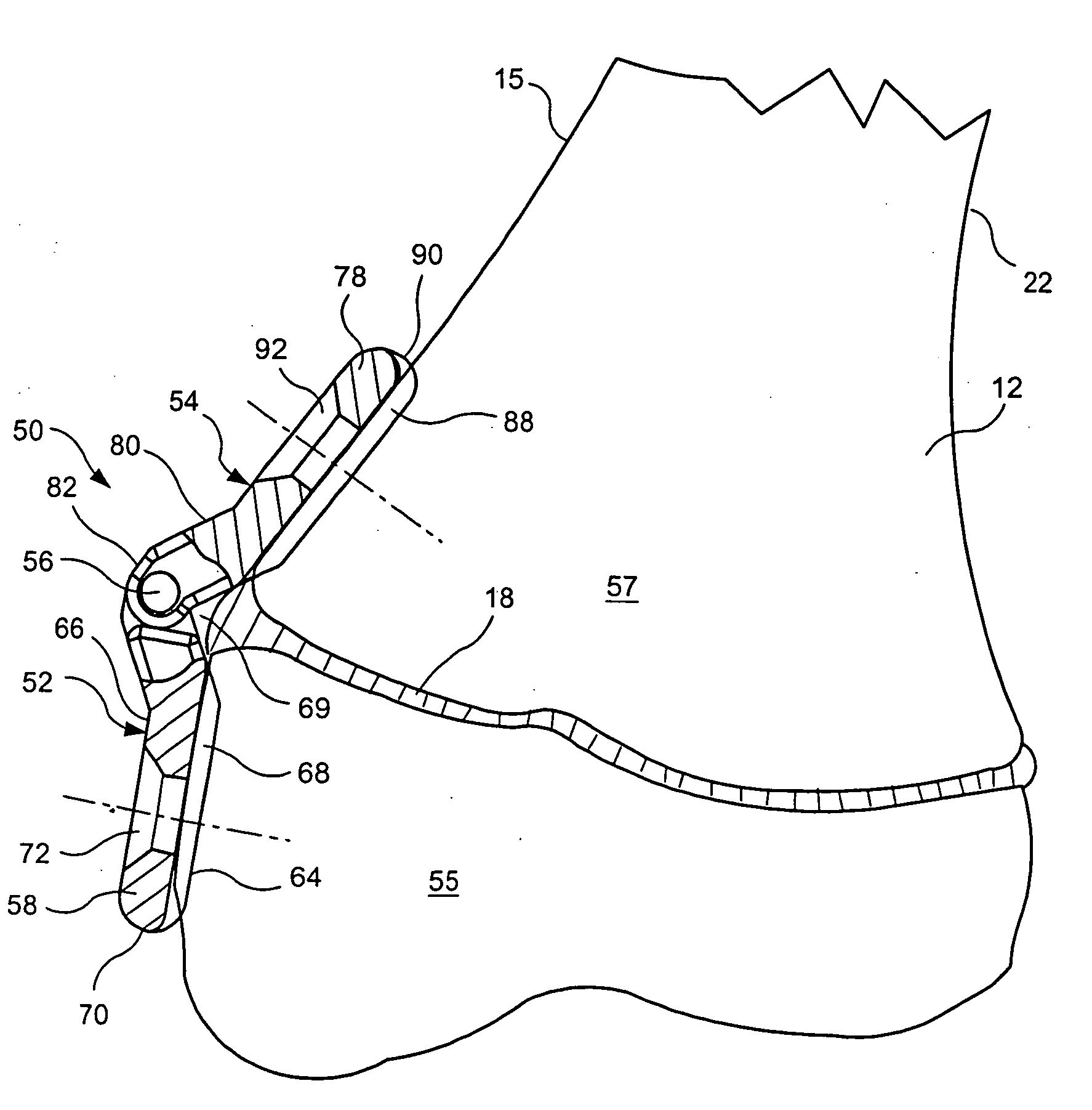 Orthopedic method for correcting angular bone deformity