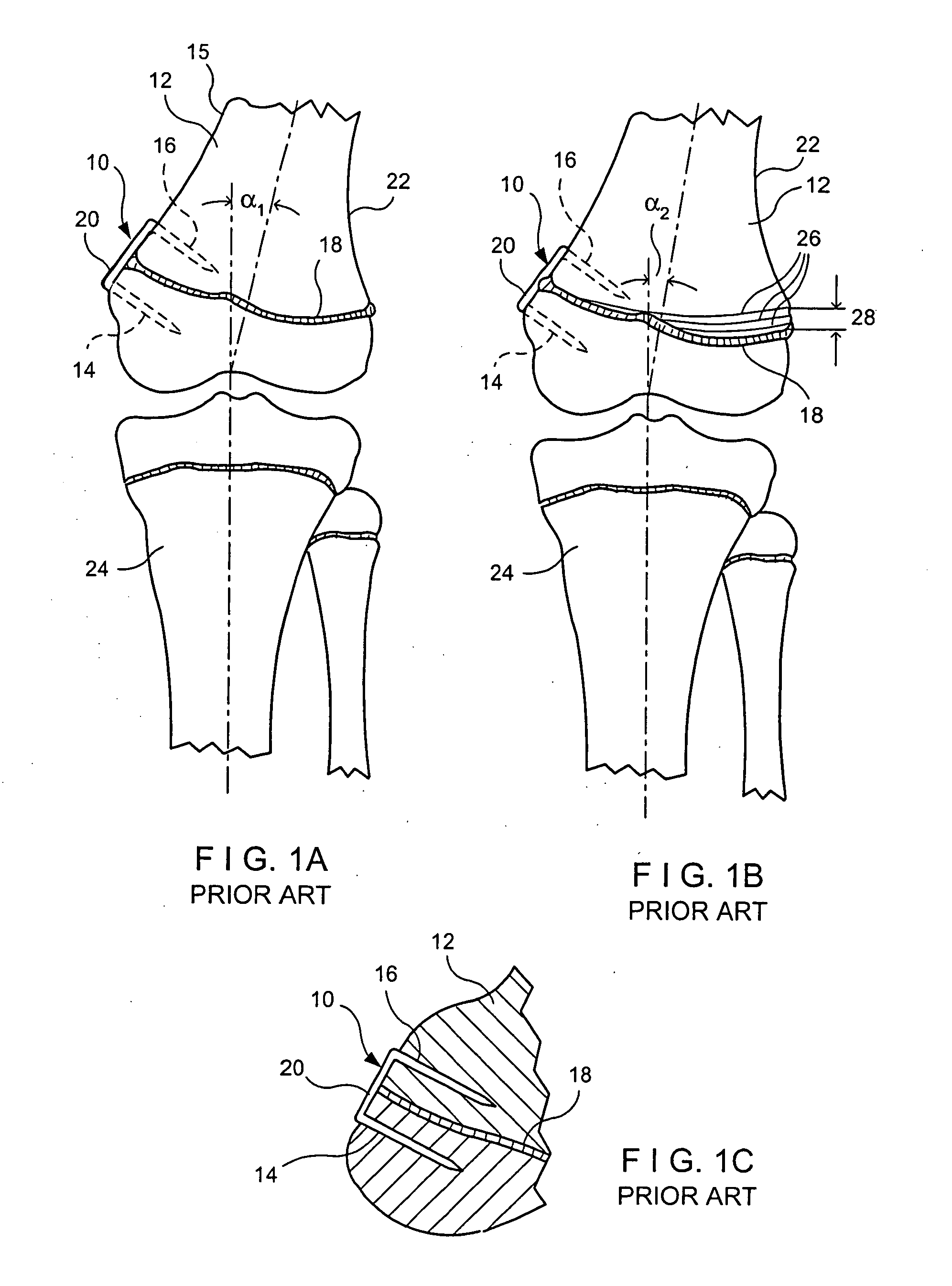 Orthopedic method for correcting angular bone deformity