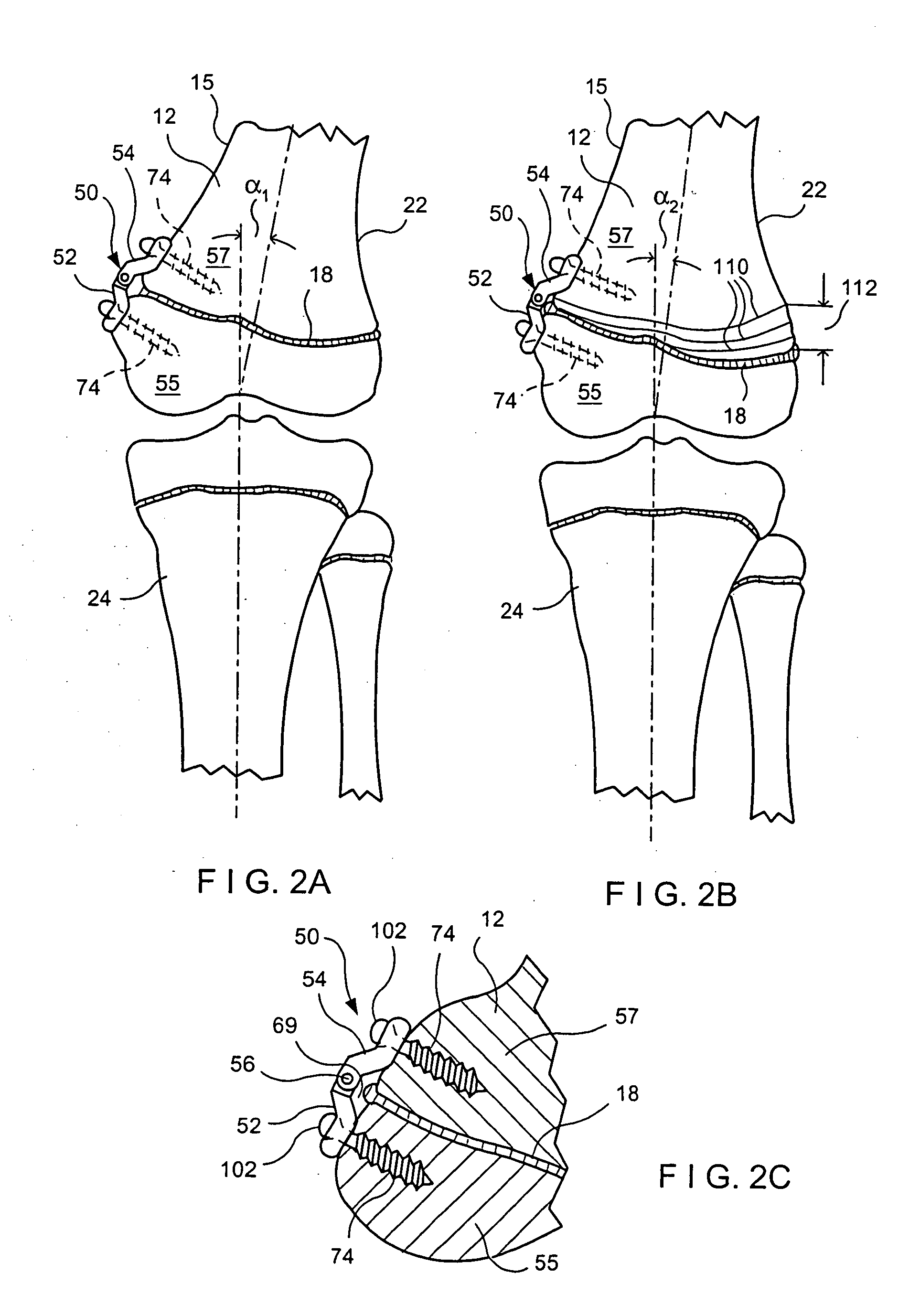 Orthopedic method for correcting angular bone deformity