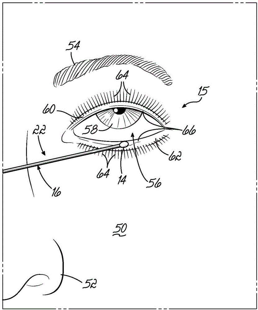 Device for treating an ocular disorder