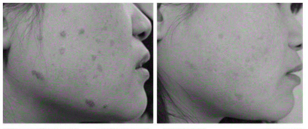 Application of effective site of salvianolic acids to preparation of preparations for treating skin diseases