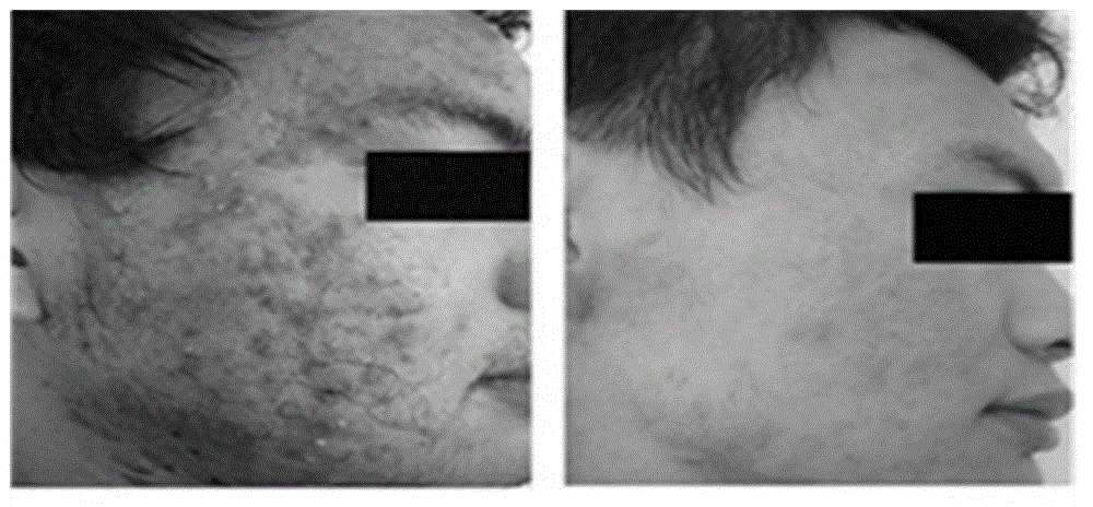 Application of effective site of salvianolic acids to preparation of preparations for treating skin diseases