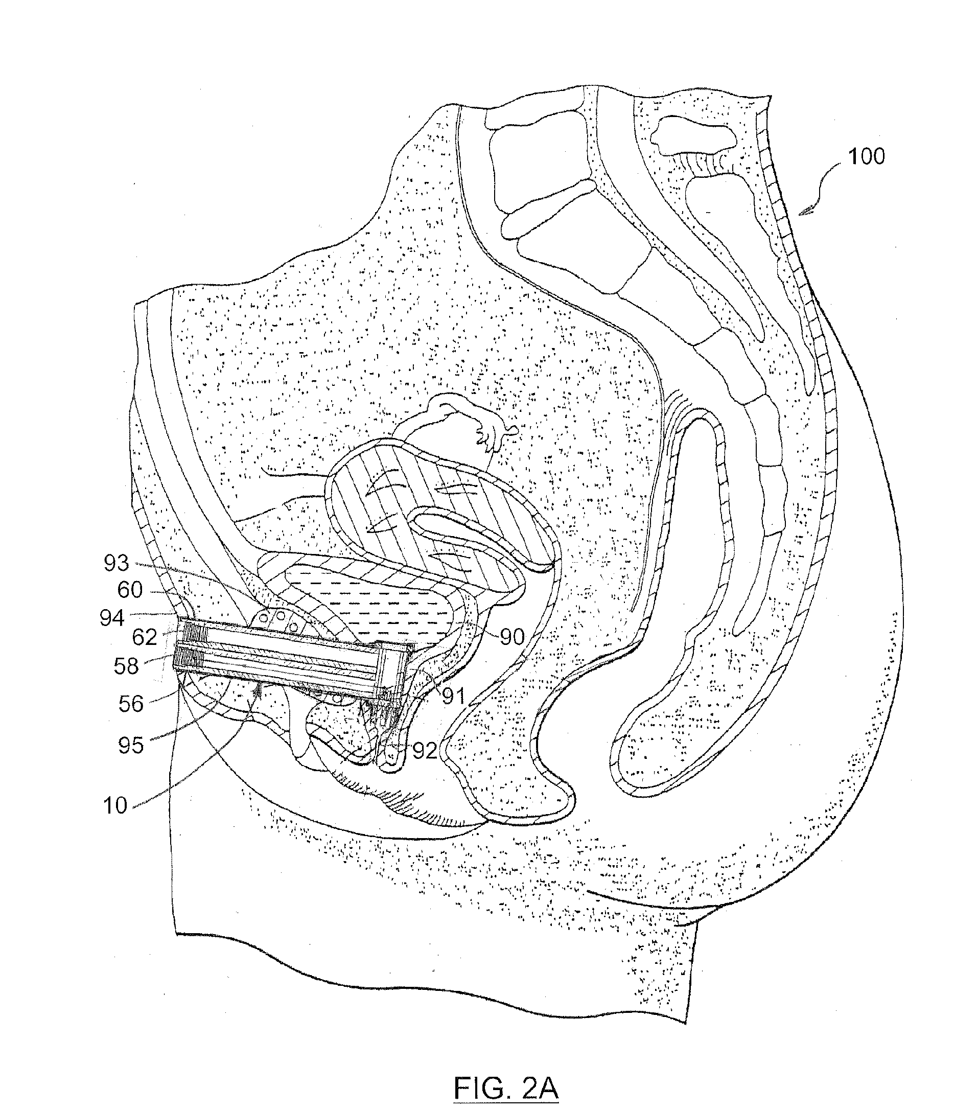 Apparatus and method for correcting urinary incontinence