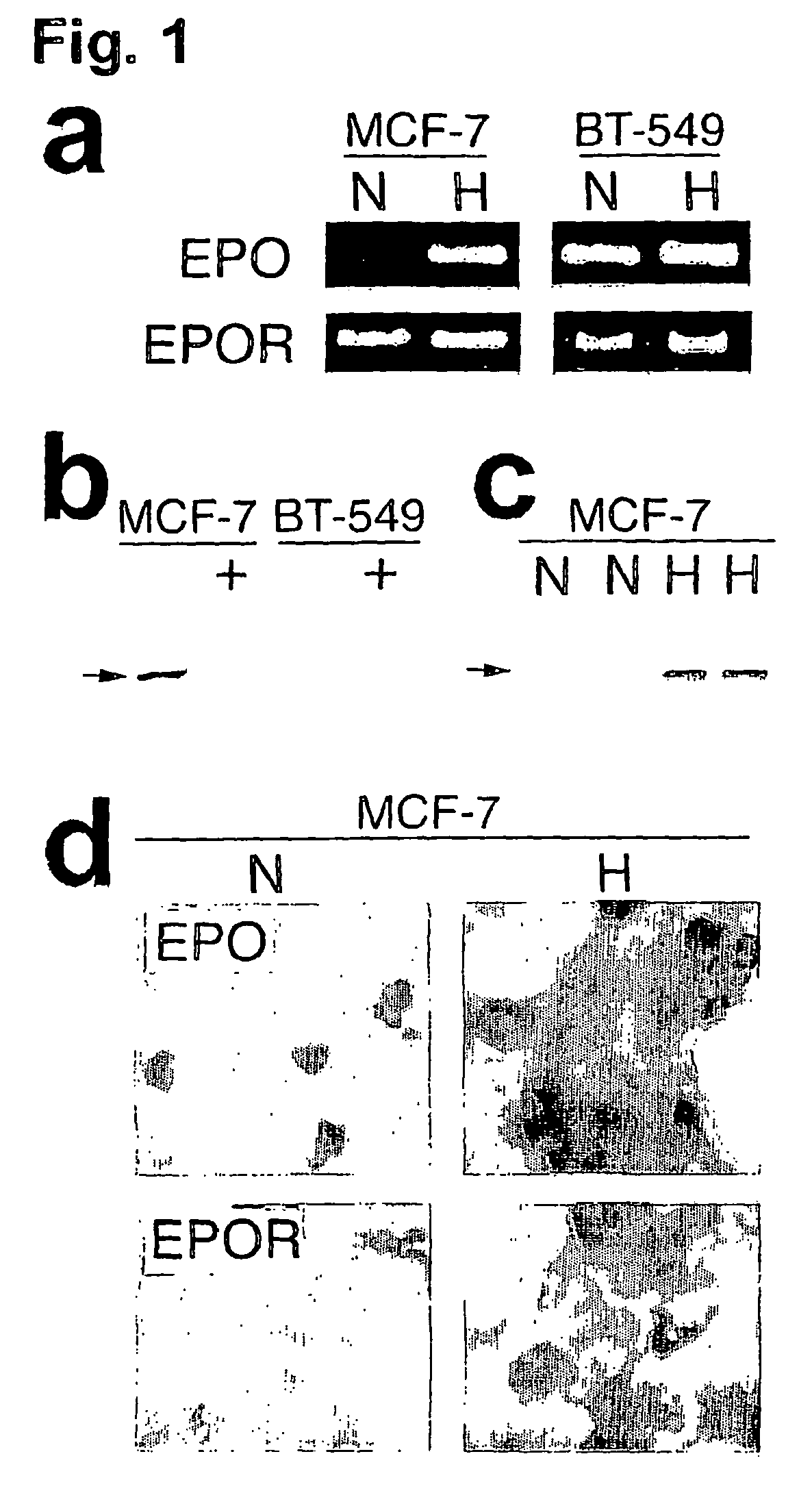 Erythropoietin and erythropoietin receptor expression in human cancer