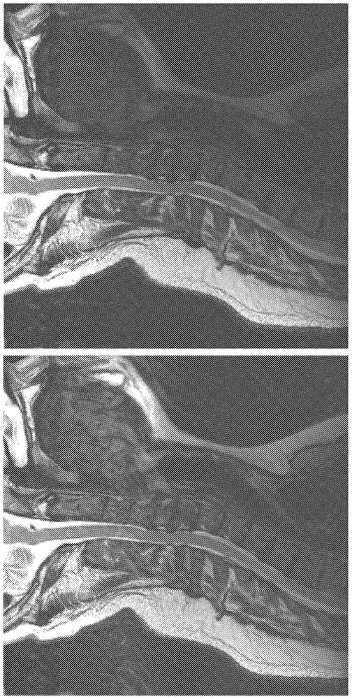 Channel-by-channel artifact reduction in parallel MRI