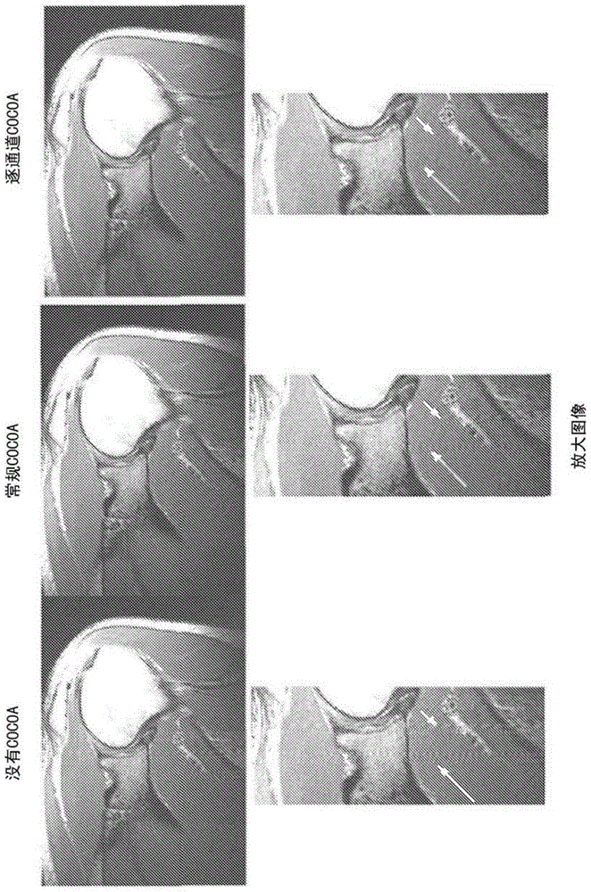 Channel-by-channel artifact reduction in parallel MRI