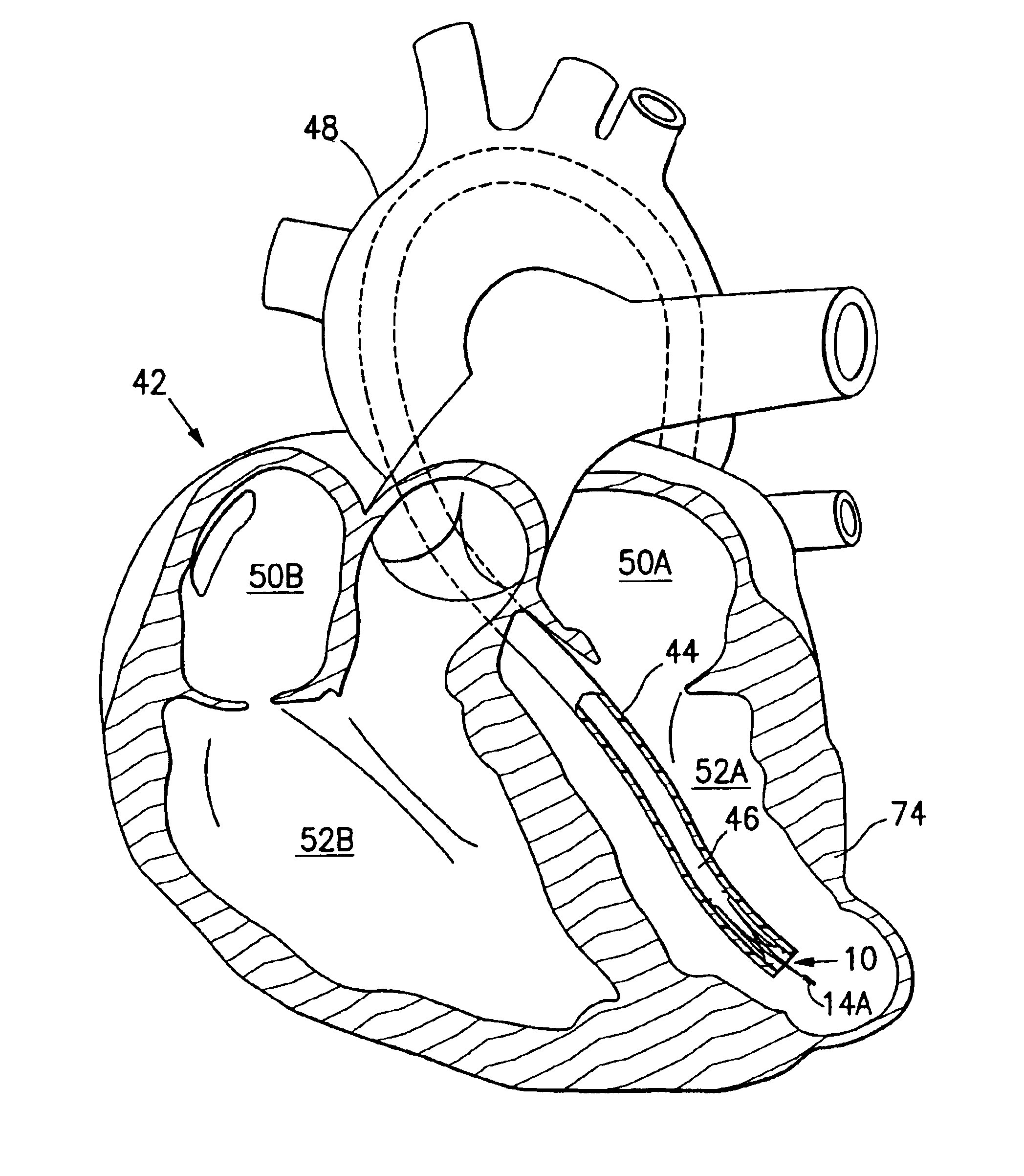 Method for improving cardiac function