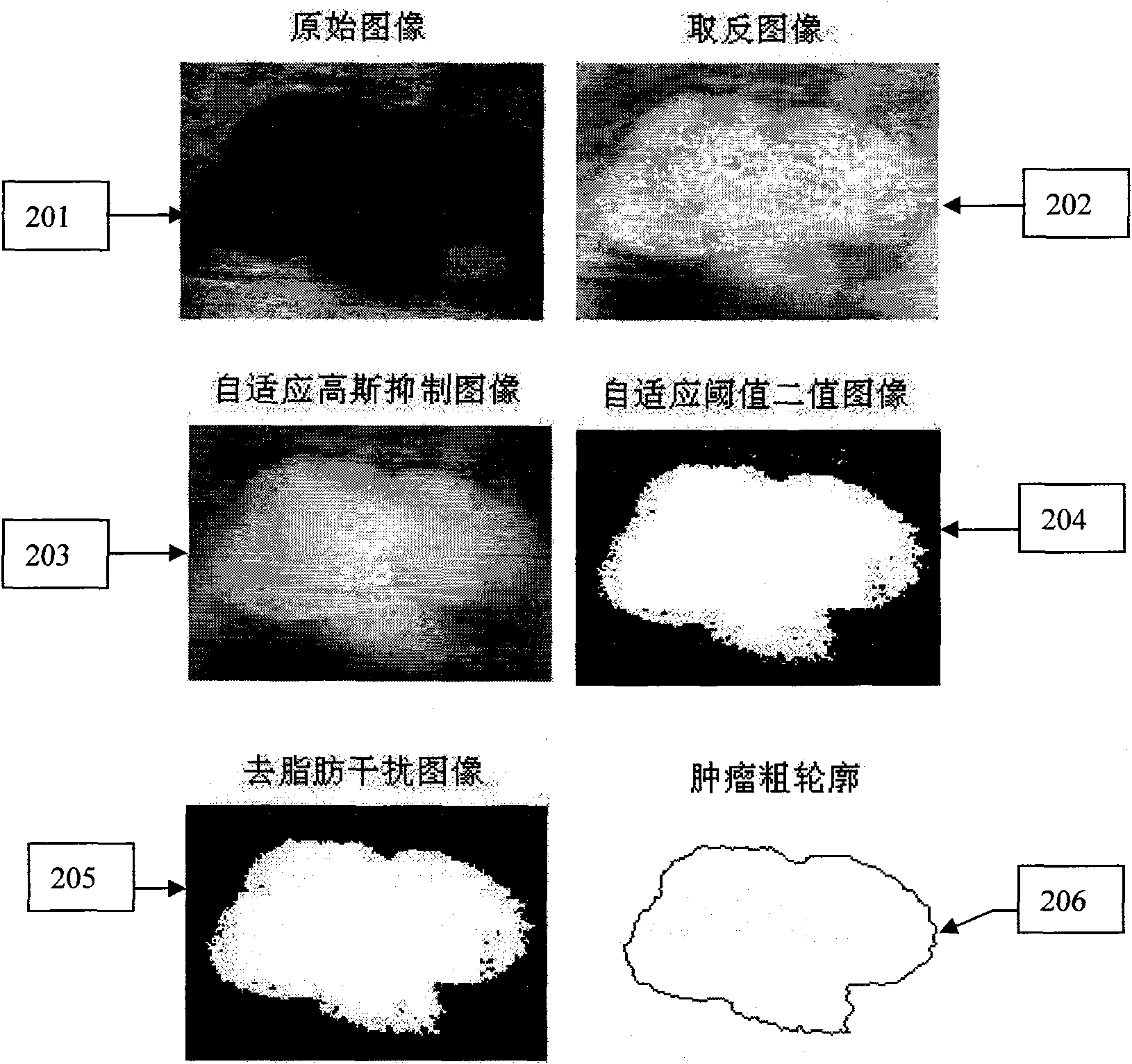 Method for outline extraction of level set medical ultrasonic image area based on edge and statistical characteristic