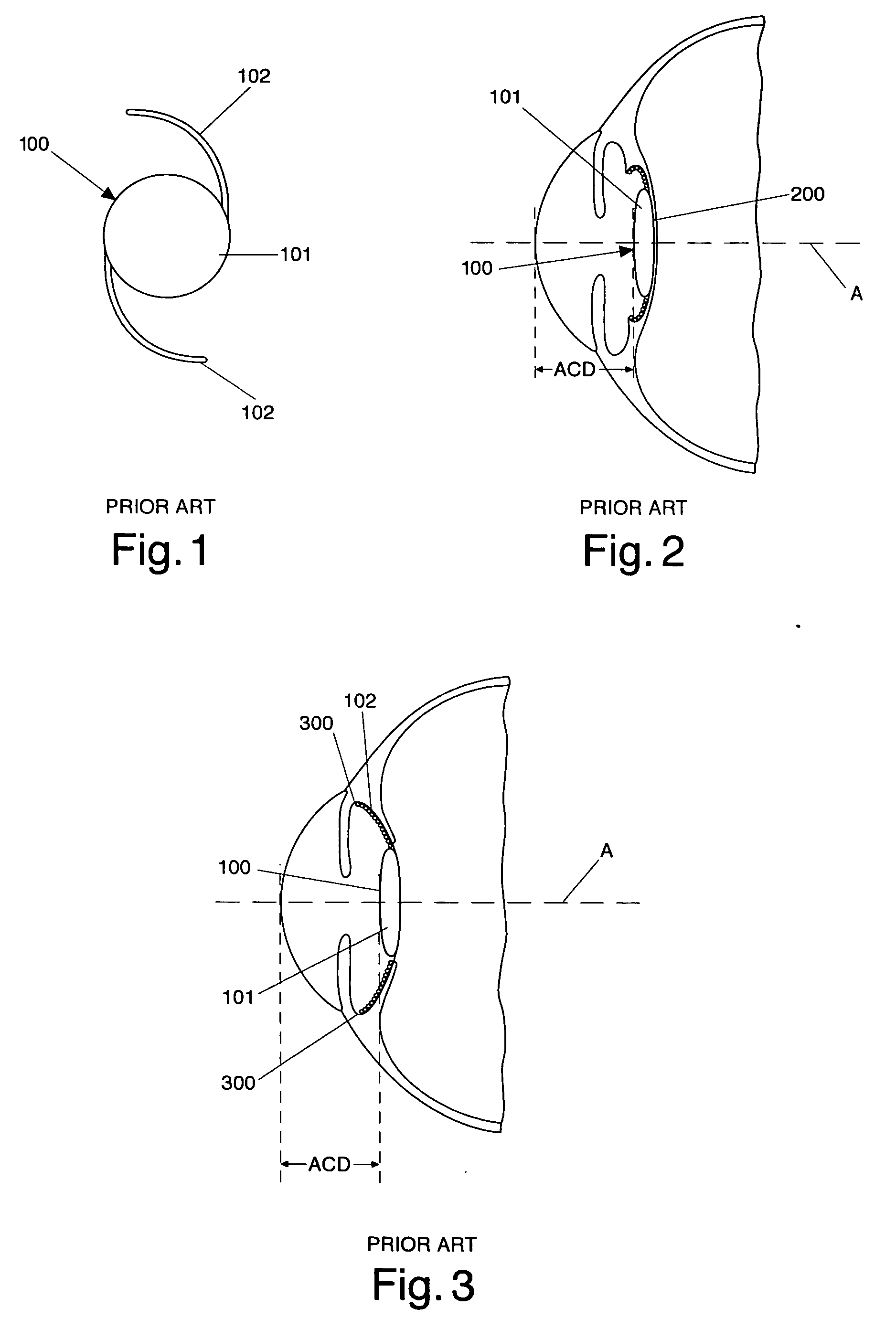 Accommodating intraocular lens implant