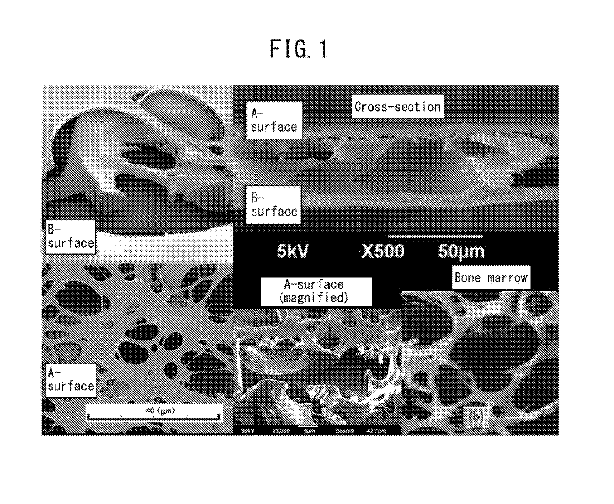 Implant and kit for treatment of bone lesion site, as well as method for treating bone lesion site