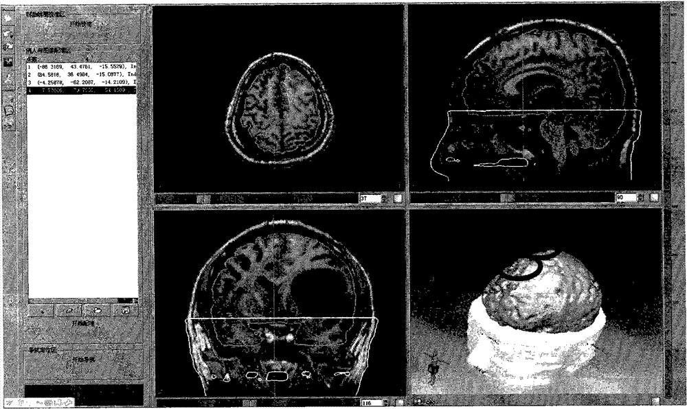 Navigation transcranial magnetic stimulation treatment system