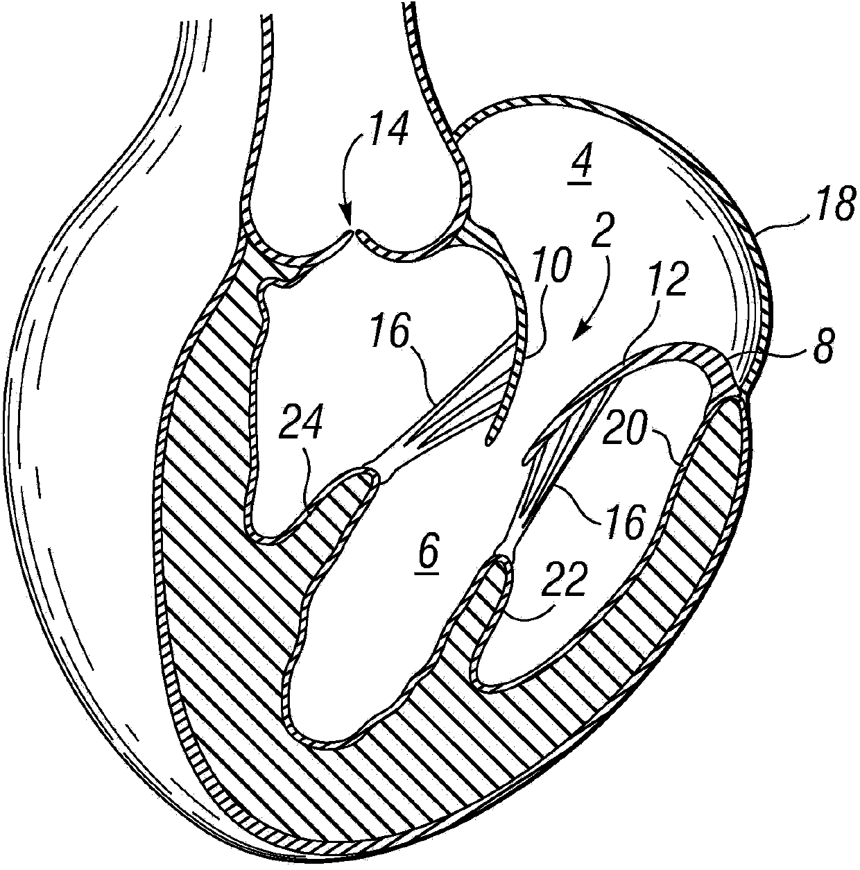 Prosthetic valve for replacing mitral valve