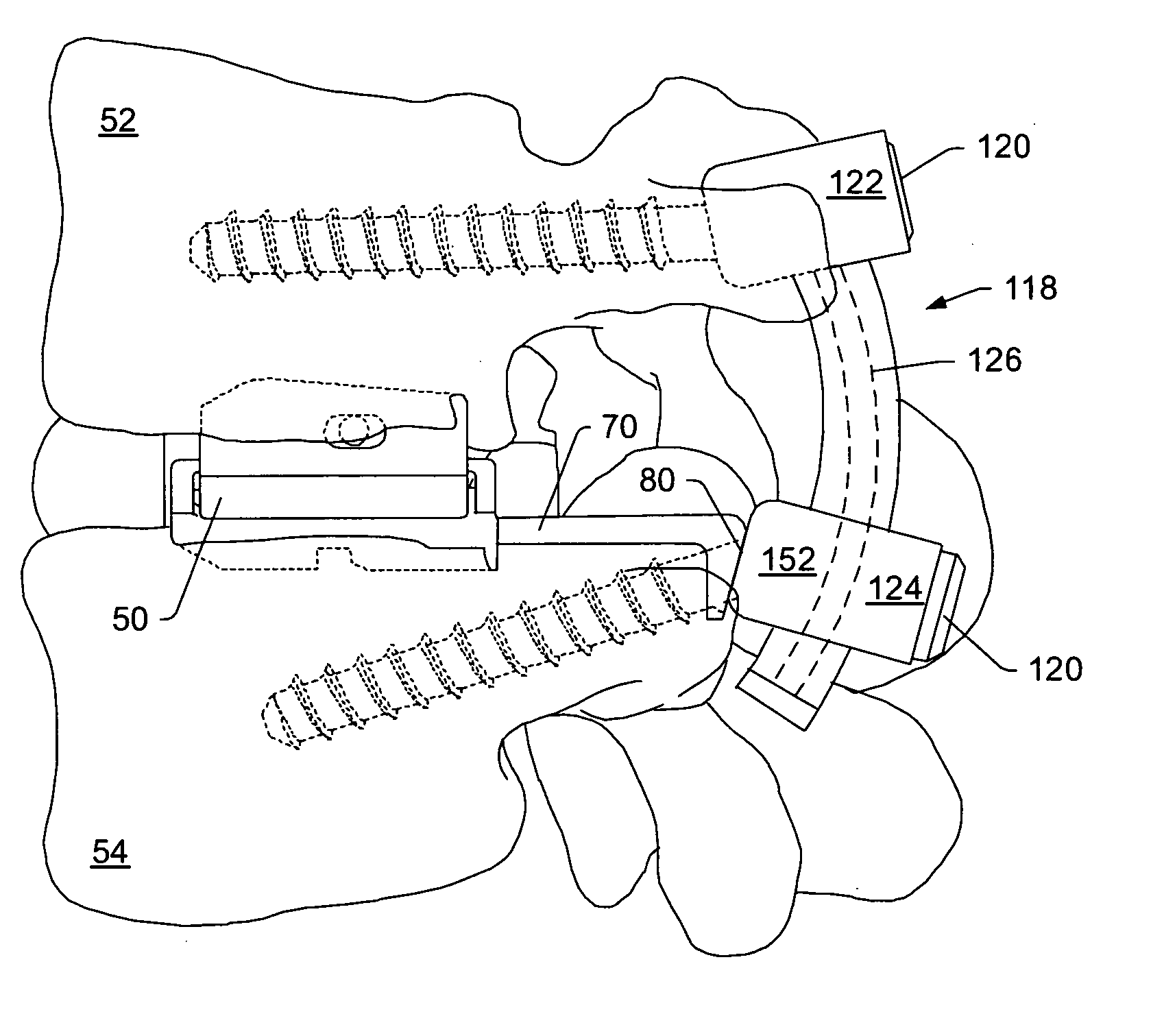 Artificial functional spinal unit system and method for use