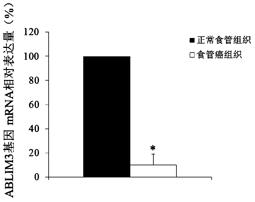 The use of ablim3 gene as a marker for the diagnosis and treatment of esophageal cancer