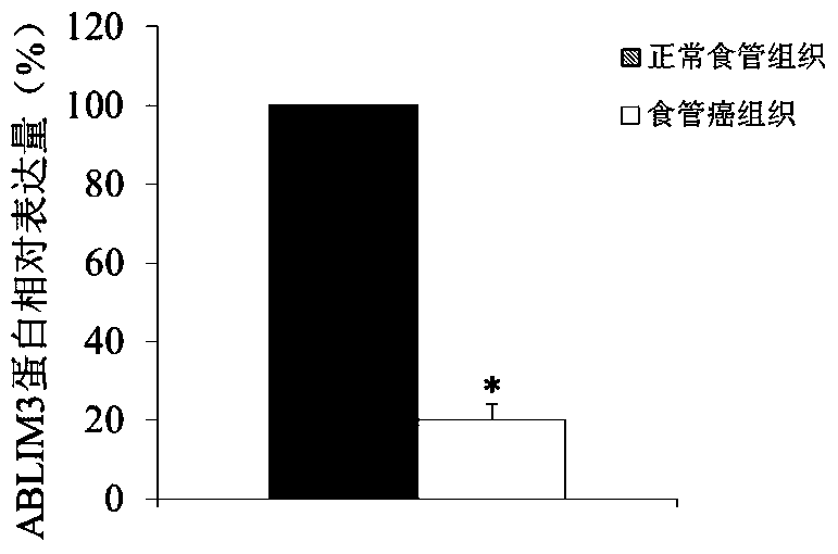 The use of ablim3 gene as a marker for the diagnosis and treatment of esophageal cancer