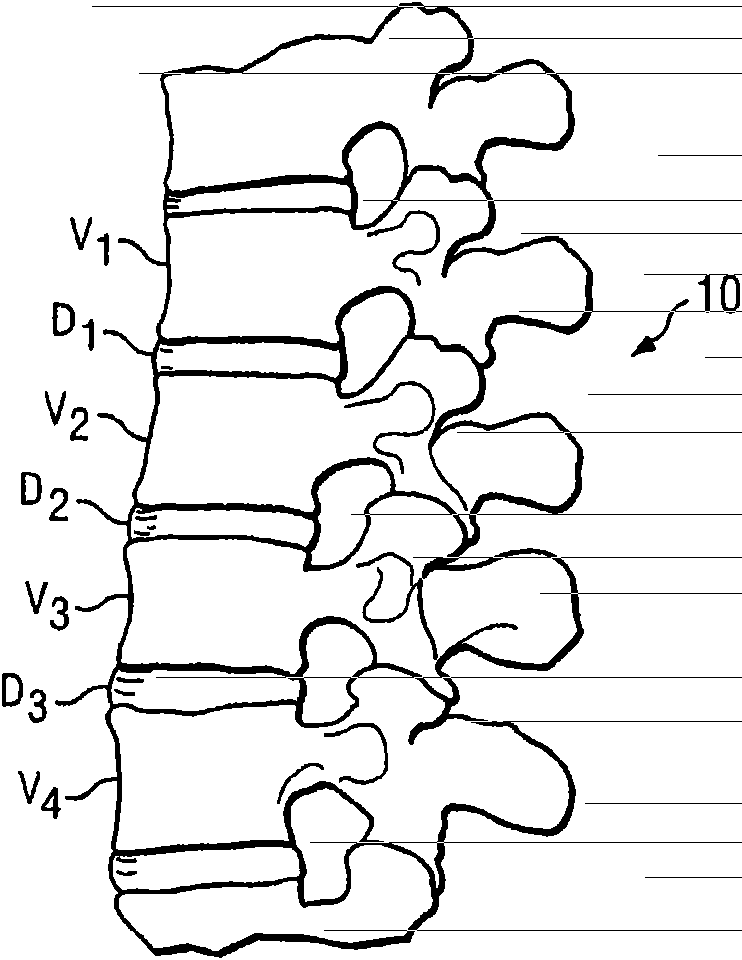 Posterior total joint replacement