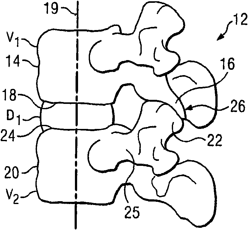 Posterior total joint replacement