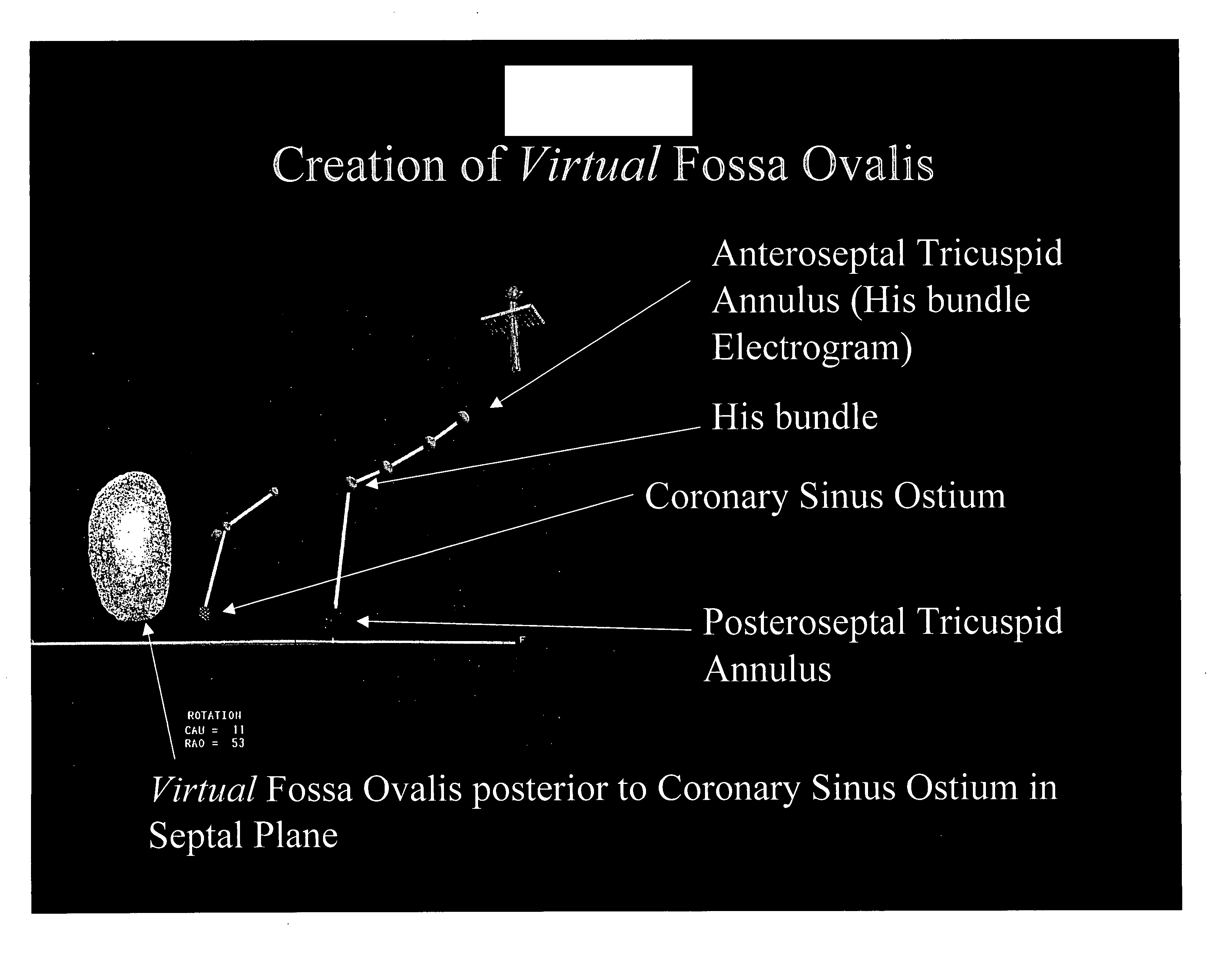 Method and apparatus for locating the fossa ovalis, creating a virtual fossa ovalis and performing transseptal puncture