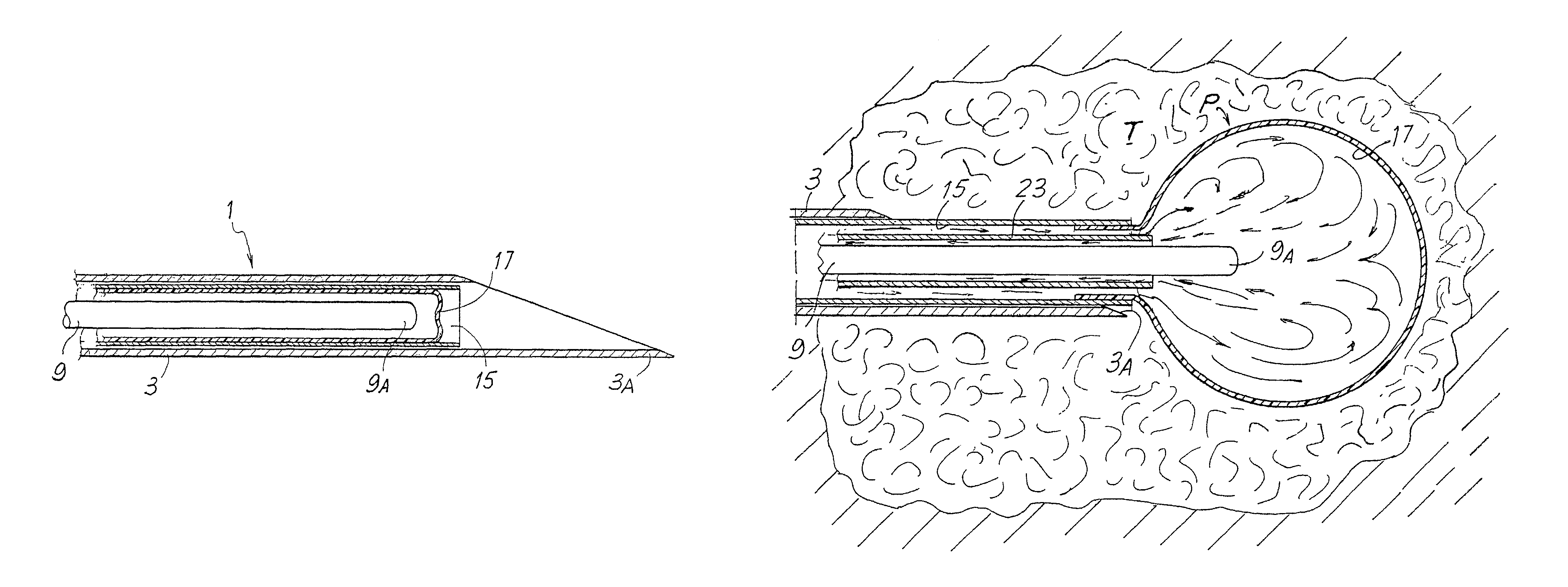 Device and equipment for treating tumors by laser thermotherapy