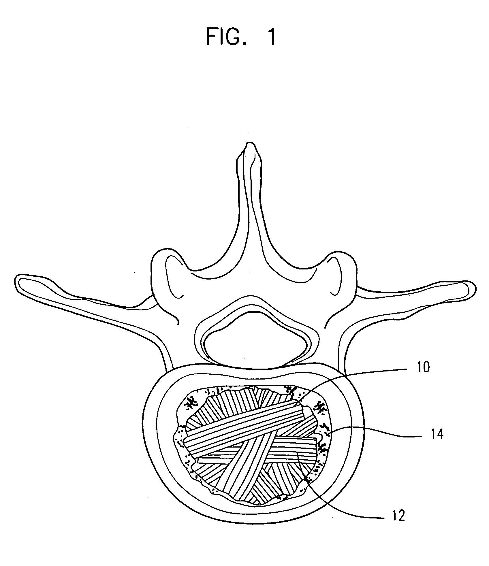 Semi-biological intervertebral disc replacement system