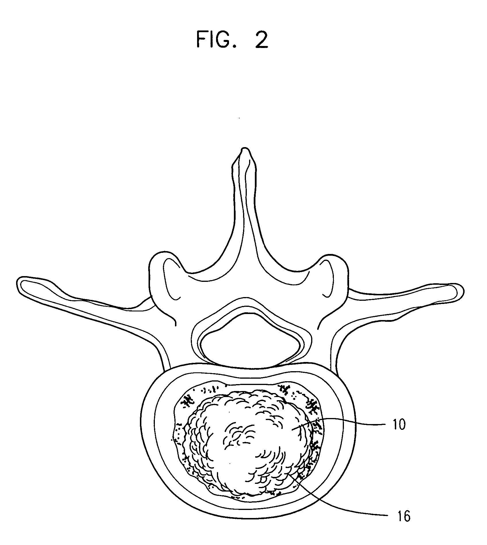 Semi-biological intervertebral disc replacement system