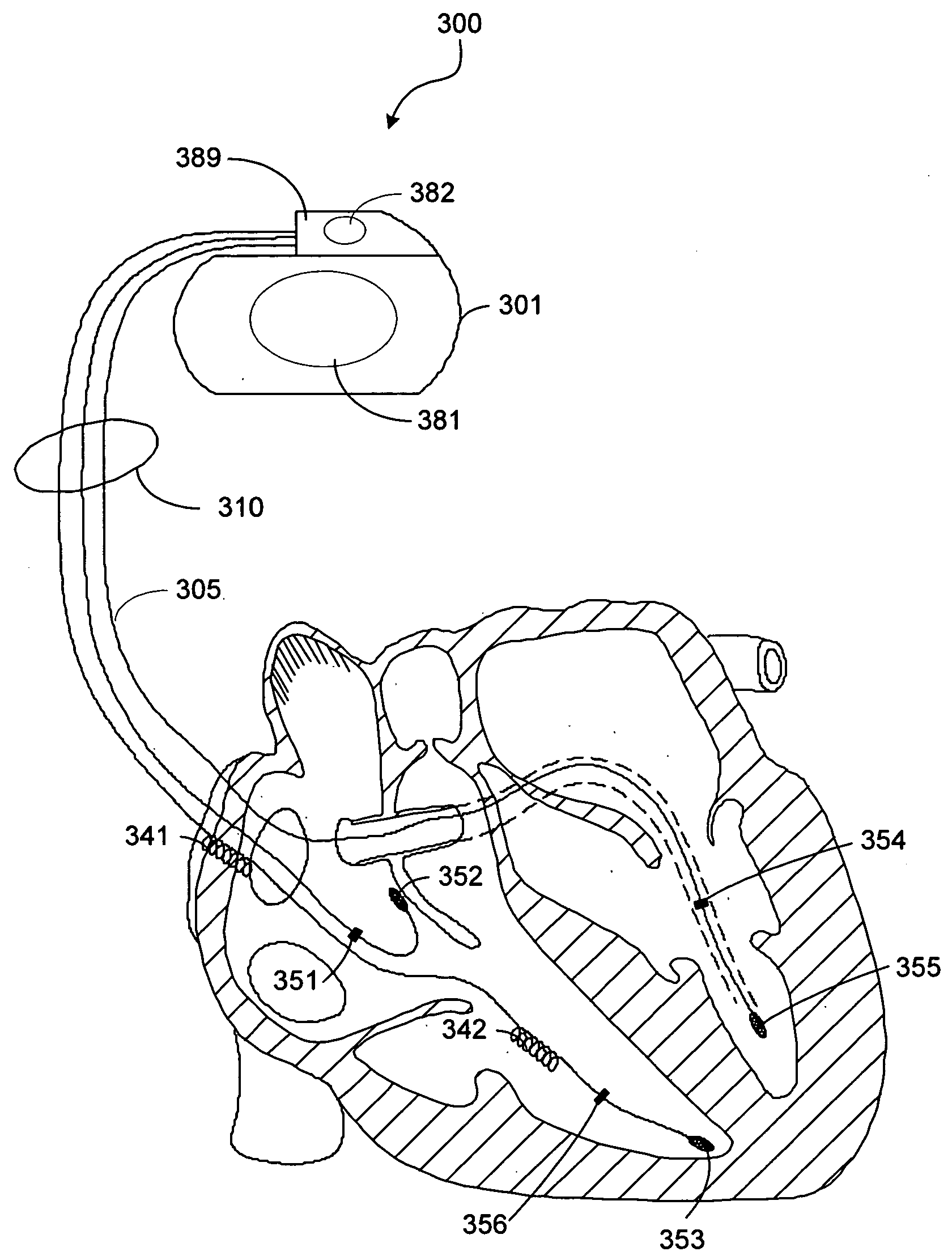 Therapeutic electrical stimulation that avoids undesirable activation