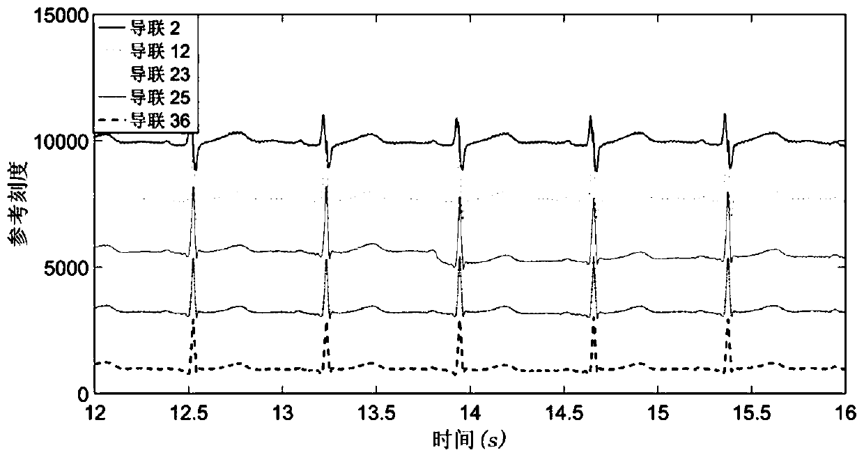 Atrial fibrillation analysis and prediction method based on cardiac mapping excitation sequence diagram