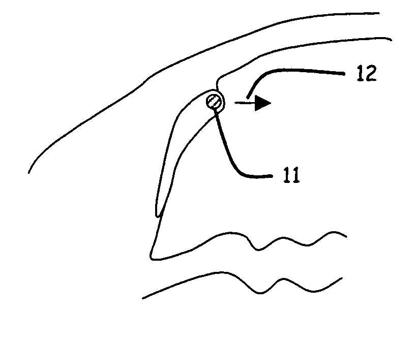 Ophthalmic implant for treatment of glaucoma