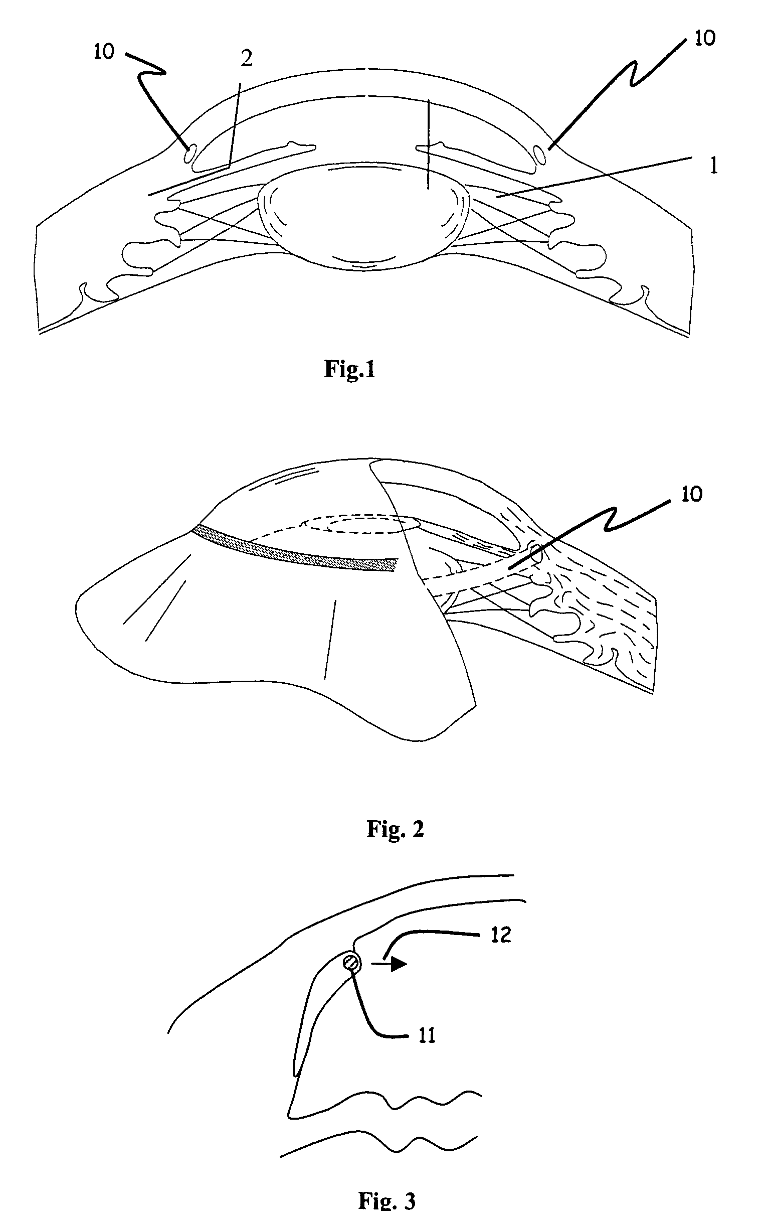 Ophthalmic implant for treatment of glaucoma