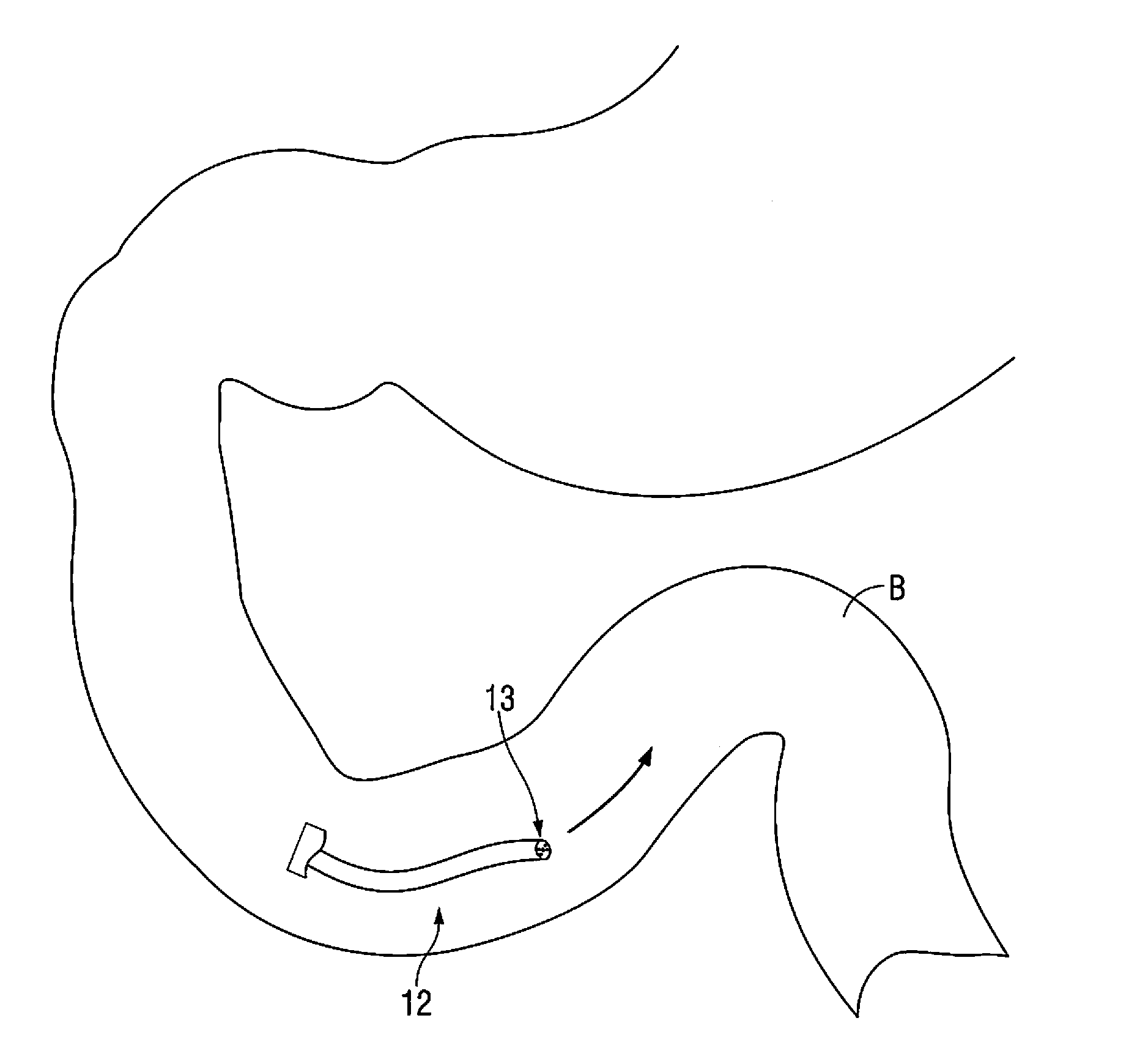 Gastric bypass system and method