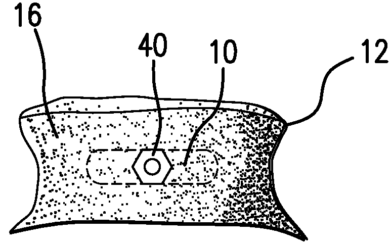 Annular repair device and method