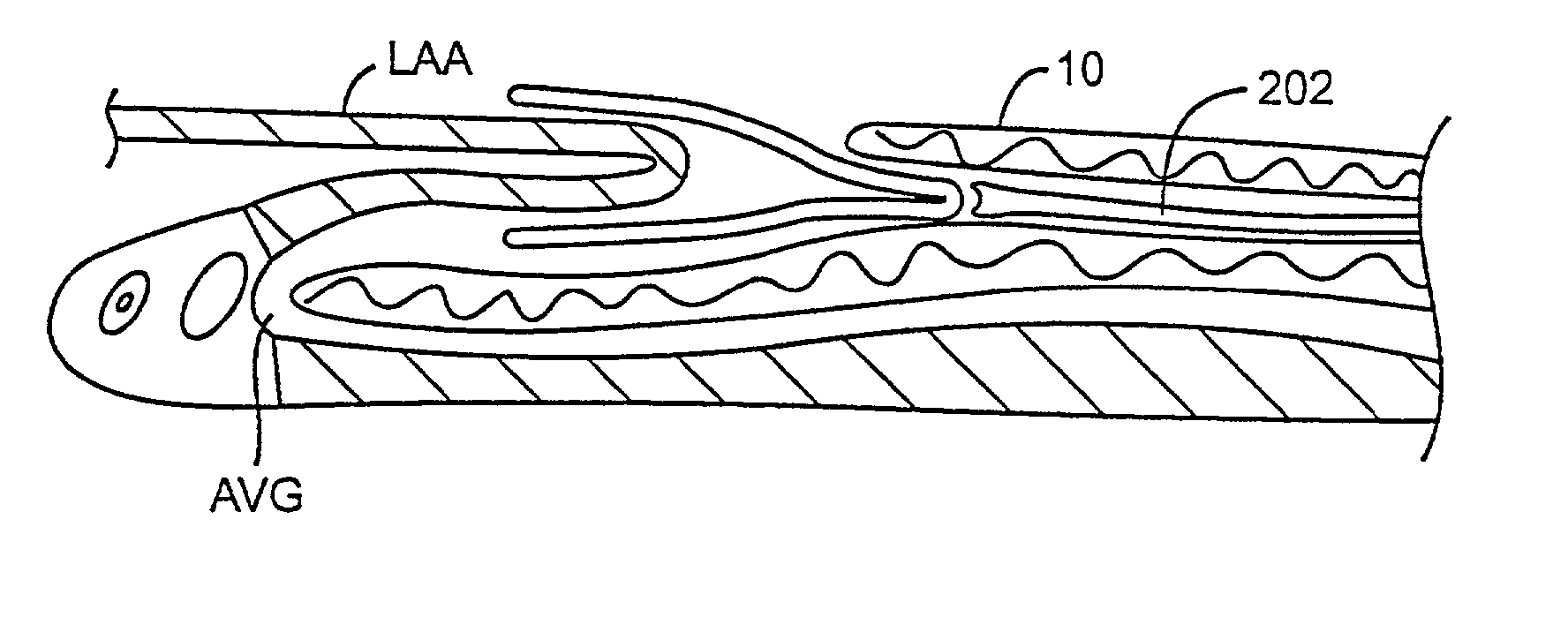 Methods and apparatus for transpericardial left atrial appendage closure