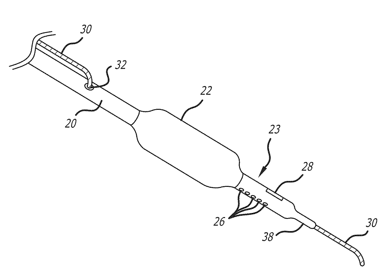 System and methods for treating mvo