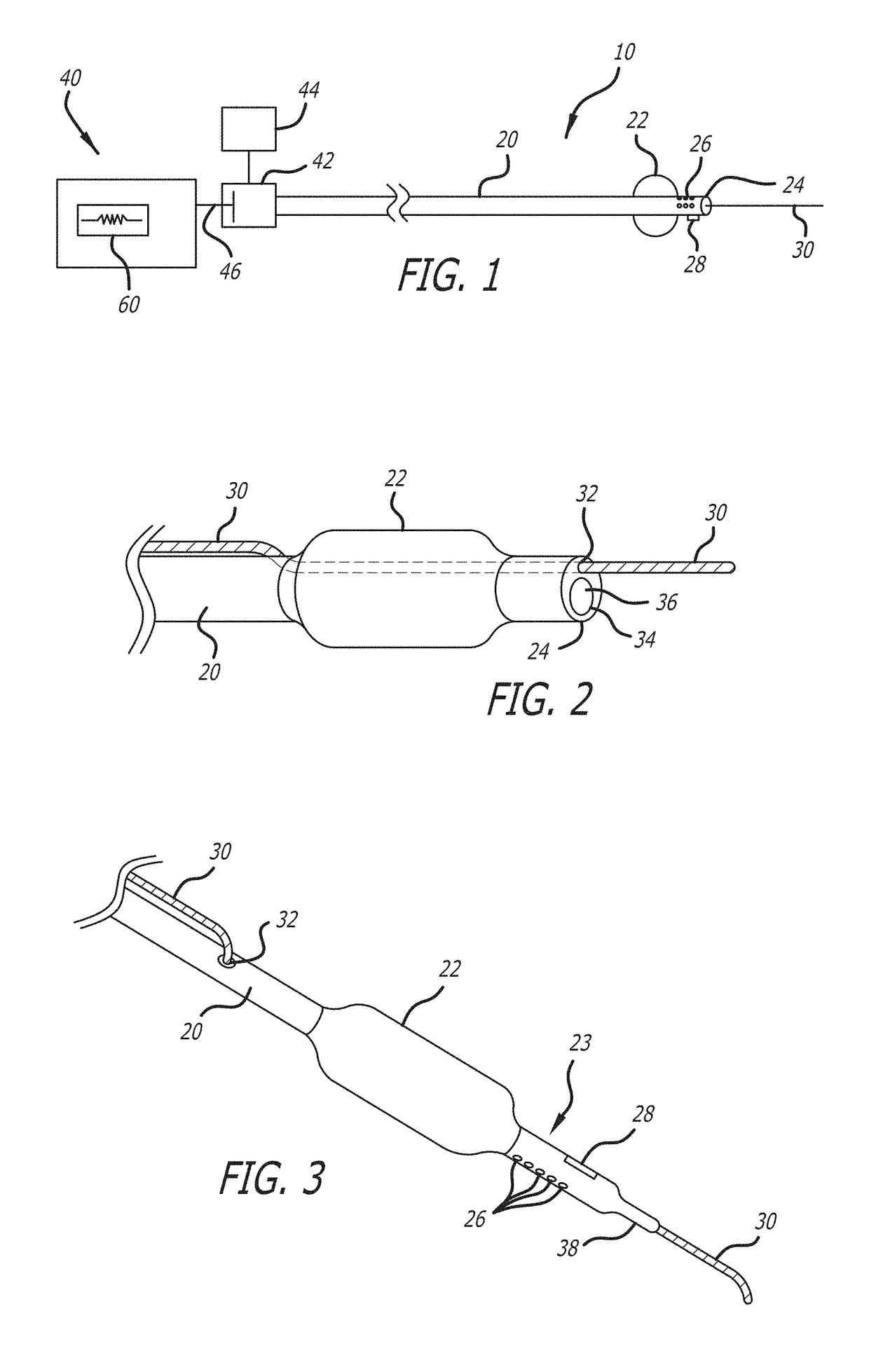 System and methods for treating mvo