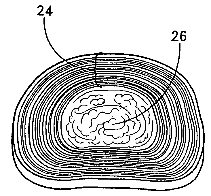 Method of spinal fixation using adhesive media